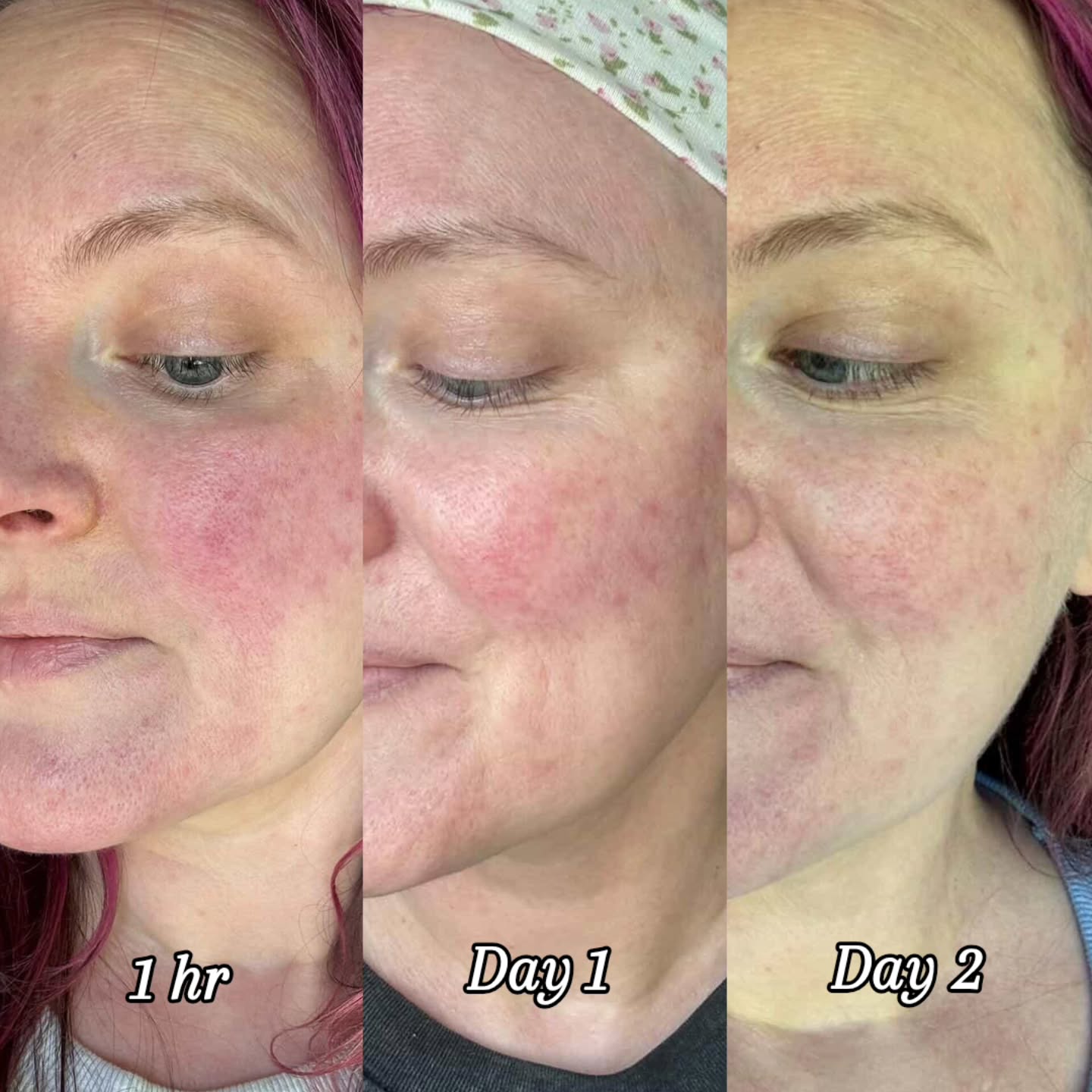 Post Calm Facial + Corrective Polite Peel
... I'm flabbergasted. Truly. LOOK at these results!
Redness has gone down significantly. Hydration and texture has improved.
What can be expected: purging of congestion and acne that will come to the surface faster, as well as pigmentation rising and appearing darker so that it can be sloughed away.
No downtime either. You can workout, wear makeup, and continue living your life. Just make sure you're taking care of your skin at home with gentle products, and wear SPF daily, preferably every 2 hours. That's it!
1 session can make such a difference, but imagine was a series of 3 will do!
#sensitiveskinspecialist #haleandhush #correctiveskincare #dmvesthetics #frederickfacials