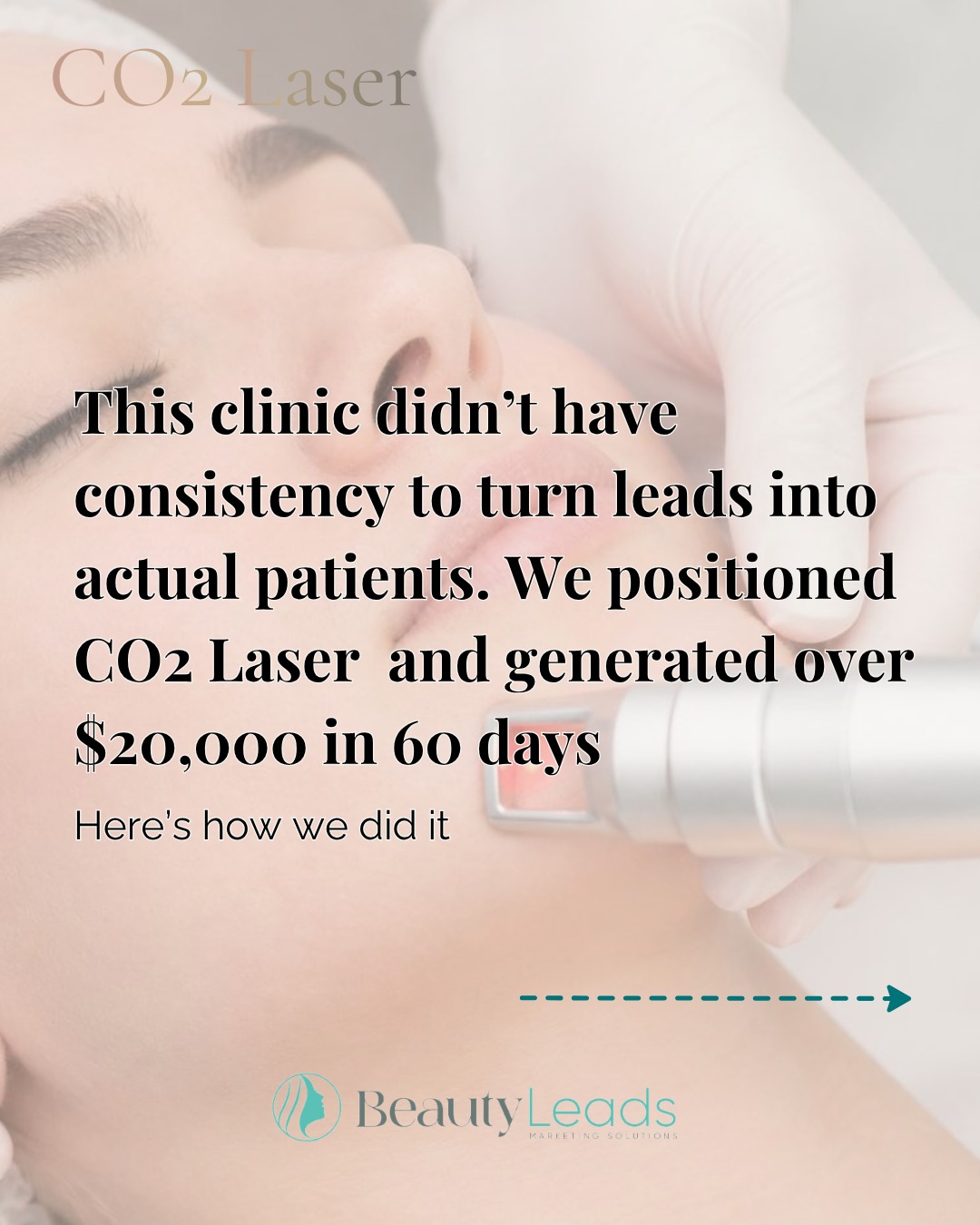 If your clinic is already investing in ads but the return doesn’t match the level you operate at, read this carefully.
Because this is where most clinics get it wrong.
They have a structure problem.
They’re running ads, generating leads, and even getting enquiries.
But that focus is directed to the wrong place:
– Generic treatments
– Low-intent patients
– Offers with no clear positioning
Enquiries and leads approach may be keeping the clinic busy, but don’t actually drive consistent revenue at all.
So even when the marketing campaigns are running, the business doesn’t have the right positioning.
This clinic already had a high-value treatment: CO2 Laser.
Demand was there.
Interest was there…
But:
– Bookings were unpredictable month to month
– Structure from enquiry → consultation → treatment was generic and lacked definition
– There was no system to support consistent conversions
Not because ads don’t work, and not because patients don’t want the treatment.
But because the strategy behind the campaigns wasn’t aligned with how real revenue is built.
So we shifted the focus: redefining CO2 Laser treatment positioning aligned with real outcomes.
From how it was positioned in the market to how it was communicated to the right type of patient.
And structured the entire journey:
from first click → to consultation → to treatment.
Because high-ticket patients don’t behave like low-ticket ones:
They don’t buy impulsively, they make a decision based on CLARITY and TRUST.
Once this is in place, everything changes.
Within 60 days:
$24,208 generated from clear marketing positioning
Revenue scaled from $8,678 → $15,530/month
Conversion rates improved
And predictable bookings.
That’s what happens when demand is structured properly…
not just generated.
If your clinic is already investing in ads
but you know the return should be higher…
send me a DM with the word SYSTEM
I’ll show you how we build this for clinics operating at your level.