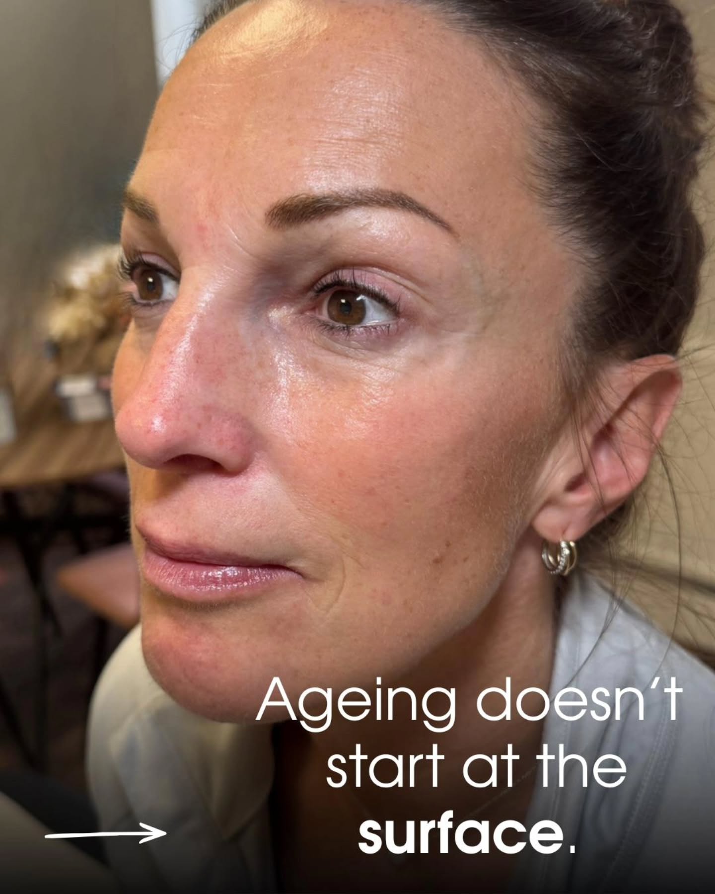 🤍✨ AGEING IS DEEPER THAN SKIN ✨ 🤍
Ageing doesn’t start on the surface… it starts beneath it. ✨
Over time, the structures that support your face begin to shift, soften, and lose volume — even when your skin still looks “good.”
That’s where Profhilo Structura comes in. 🤍
Designed to support and restore from within, helping improve firmness, contour, and overall facial balance.
Stronger structure, healthier skin, and results that feel like you — only fresher. ✨
If you’re noticing heaviness, loss of support, or changes in your facial shape… this could be exactly what you need.
DM “STRUCTURA” to book your personalised consultation. 🤍
#profhilostructura #facialstructure #naturalenhancement #aestheticswarrington #skinquality