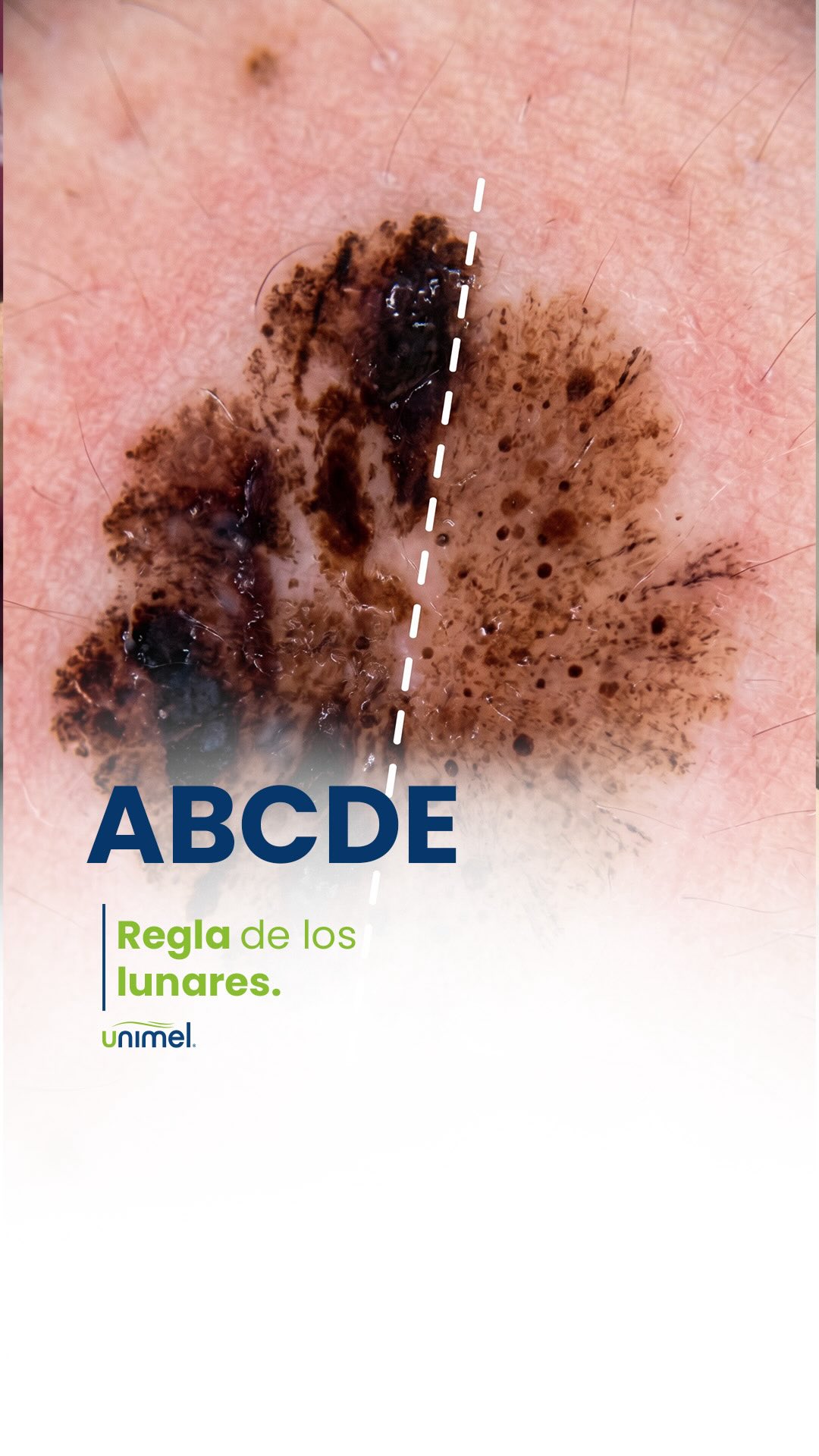 Cuidar tu piel es mucho más que usar protector solar, es conocer cada centímetro de ella. 🔎
A veces normalizamos pequeñas manchas o cambios, pensando que “siempre han estado ahí”.
Pero en el Mes de Concientización del Cáncer de Piel, queremos invitarte a transformar la observación en un acto de amor propio.
Regla de oro: Si cambia, pica, sangra o te genera dudas, ¡acude al dermatólogo! 🩺
Prevenir es ganar tiempo, salud y tranquilidad.
¿Ya revisaste tus lunares? ✨
#CuidadoDeLaPiel #PielSana #AmorPropio #Dermatología #Concientización Unimel