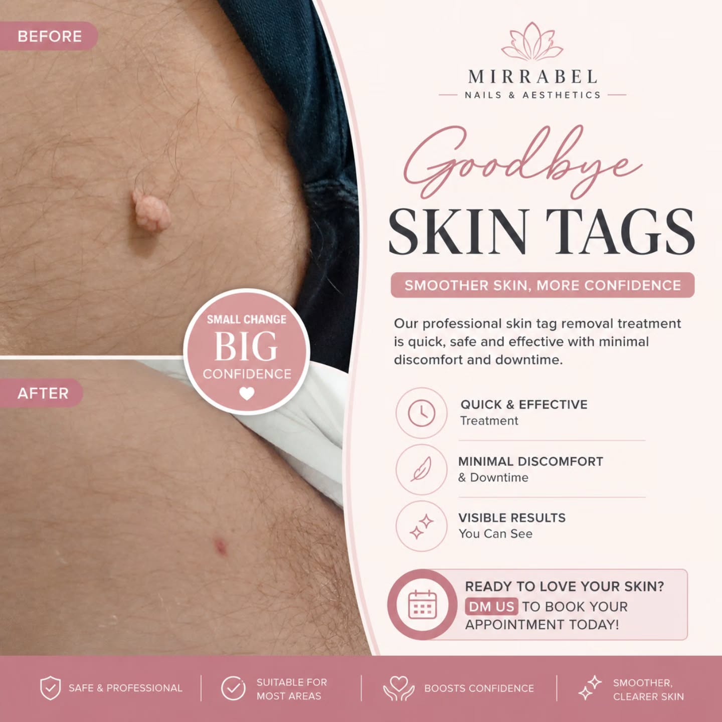 ✨ Say goodbye to unwanted skin tags ✨
Smooth, clear skin is just one treatment away 💫
Our professional skin tag removal is quick and safe giving you the confidence to feel your best again.
✔️ Minimal downtime
✔️ Instant results
✔️ Suitable for most areas
Ready to love your skin again? 💖
DM to book your appointment today!
#SkinTagRemoval #ClearSkin #AestheticClinic #SkinConfidence #BeautyCare GlowUp FlawlessSkin