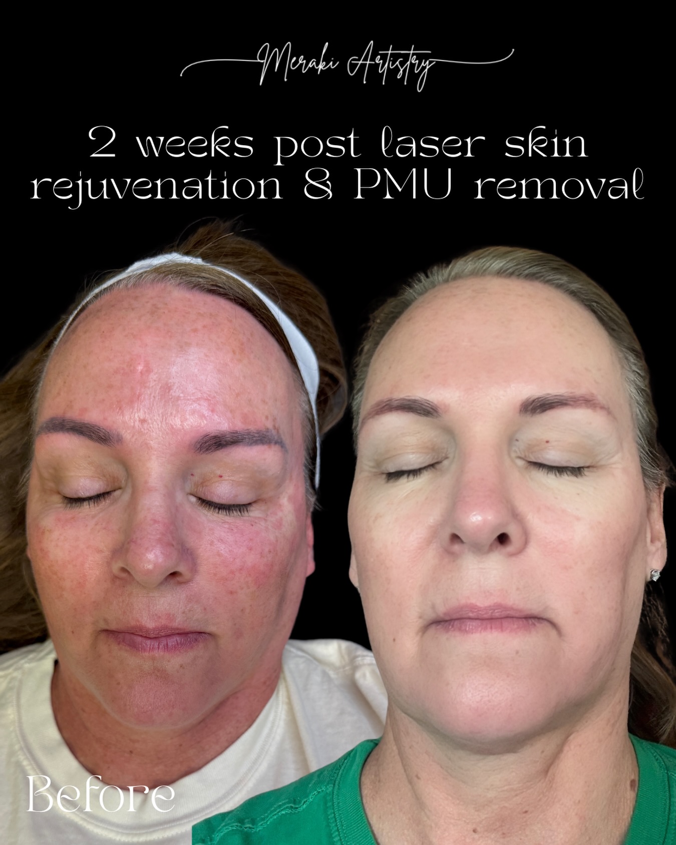 Why are we living picofy? It’s simple!
✨ It’s a “Cold” Laser Technology, because Picofy uses sound (photoacoustic) rather than heat, it is significantly safer for dark skin tones and has a lower risk of burning or scarring.
✨ Firing in Picoseconds, it shatters pigment into “dust” rather than “pebbles.” For you, this means fewer total sessions and faster clearing compared to older lasers.
Why are those two things so important? It makes treating these seamless!
✨Pigment & Sun Damage: Fade age spots, freckles, and melasma without the heat of traditional lasers.
✨Tattoo/PMU Removal: Shatter ink into “dust” for faster clearance of stubborn black and multicolored tattoos.
✨Skin Rejuvenation: Stimulate deep collagen to smooth acne scars, fine lines, and enlarged pores.
Let’s start your skin journey today, DM to build your custom package!
#picolaser #skinrejuvenation #tattooremoval