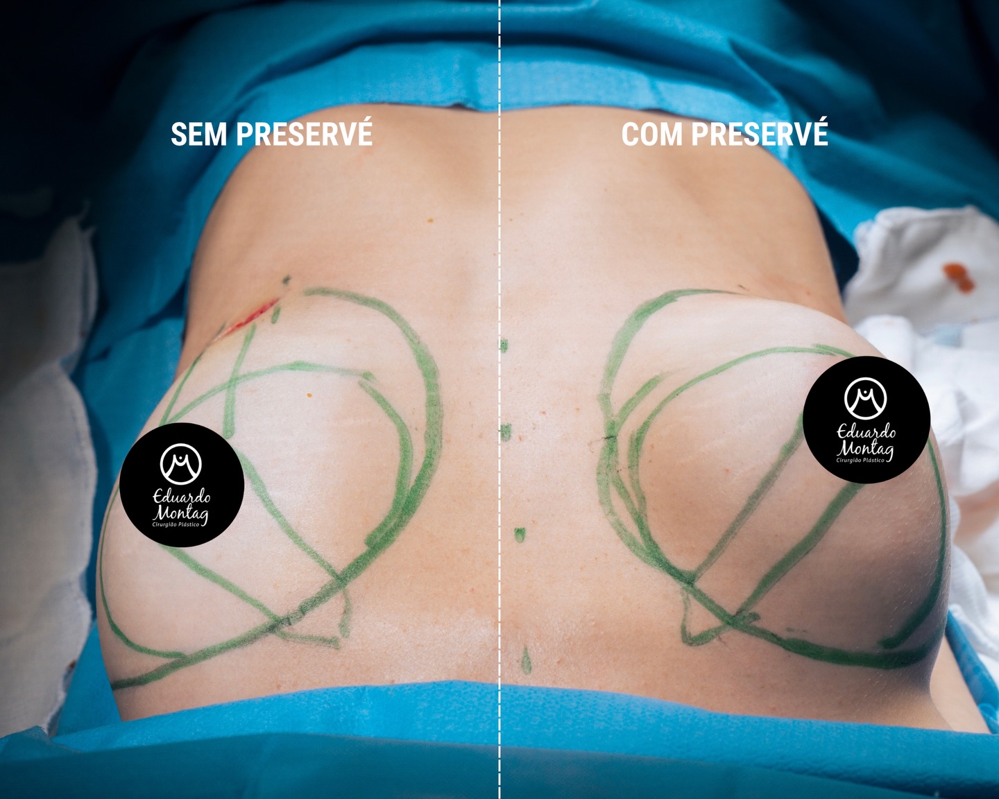 Cirurgia de hoje: uma paciente jovem, magra, em busca de um resultado natural e elegante.
Realizamos um aumento mamário com a técnica Preservé, respeitando ao máximo os tecidos e a anatomia da paciente, proporcionando um resultado discreto e harmônico.
Aqui conseguimos observar claramente a diferença entre o antes e depois da inclusão da prótese de silicone.
Naturalidade não é acaso. É técnica, planejamento e respeito à anatomia.💙