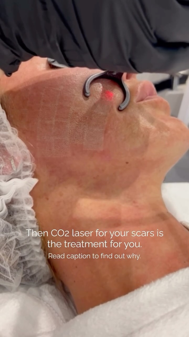Struggling with acne scars that just won’t budge? This is your sign… 👀✨
CO₂ laser is one of the most effective treatments for acne scarring and facial scars — because it works deep within the skin, not just on the surface 🤍
Here’s why it’s so powerful:
✨ Resurfaces damaged skin for a smoother texture
✨ Stimulates collagen to repair and rebuild scarred areas
✨ Breaks down old scar tissue
✨ Improves skin tone and overall clarity
✨ Creates long-term, visible results
This isn’t a quick fix — it’s a skin transformation treatment that helps you feel confident in your skin again ✨
Ready to finally tackle your acne scars?
DM now to book your consultation and start your skin journey ✨
#CO2Laser #AcneScarTreatment #SkinResurfacing #ClearSkinJourney AestheticClinic