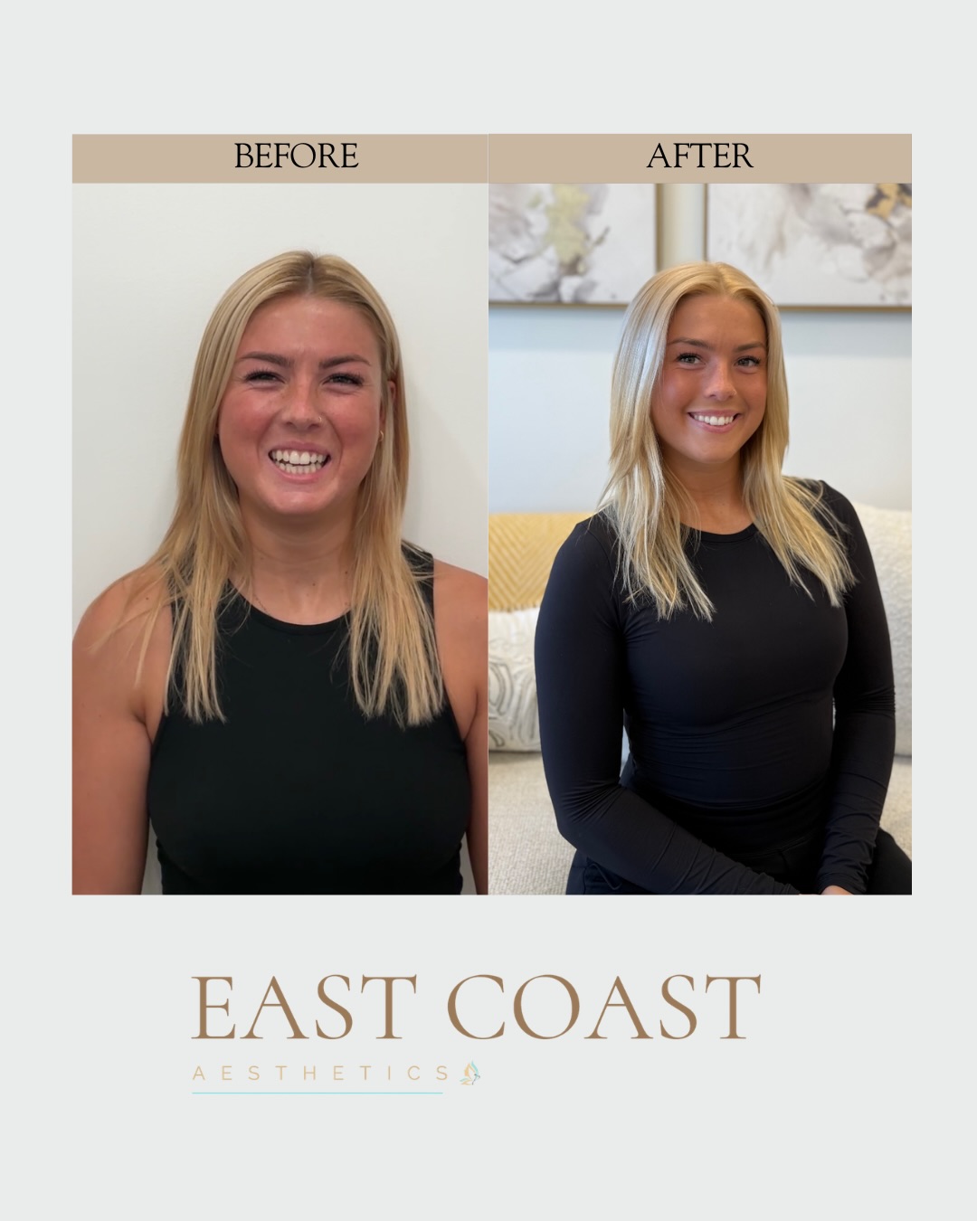 Full-face harmony, customized to her goals ✨
This transformation started with a thorough assessment to ensure every treatment worked together, masseter Botox for slimming + TMJ relief, Daxxify for smooth, radiant skin, and strategic filler to restore balance and lift.
The result? A naturally sculpted, refreshed look that still feels like her, just elevated.
Consistency with Moxi, Hydrafacials, and medical-grade skincare keeps these results glowing long-term 💫
#medspa #beforeandafter #chantillyva #moxilaser #botox