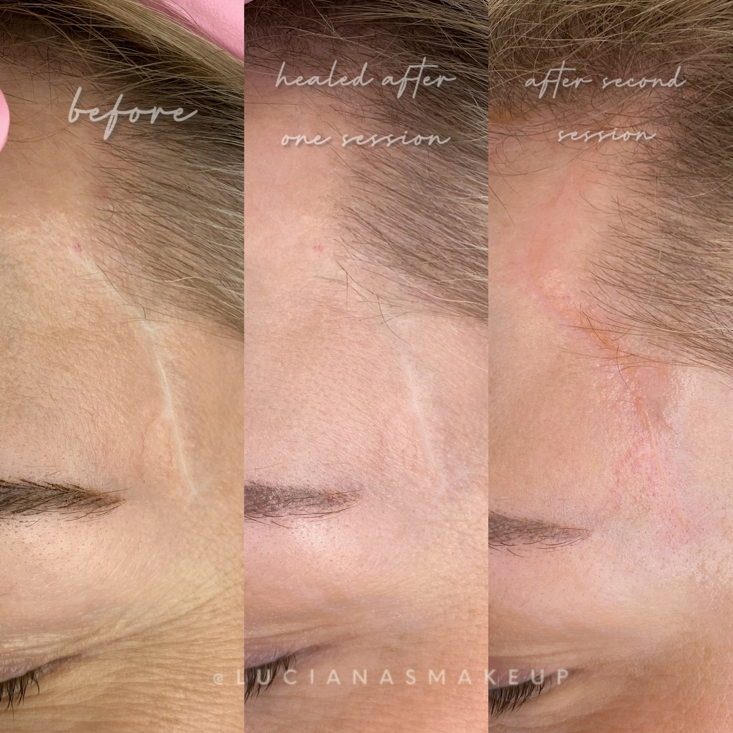 There are stories written on the skin that don’t need to be the first thing you see anymore. LuvScar camouflage is a specialized form of micropigmentation that helps blend and soften marks that once felt impossible to ignore.
I approach every treatment with a light hand and a thoughtful eye. Not to perfect… but to restore.
Because restoration is where confidence quietly rebuilds itself.
✨Let this be your invitation to learn more.
#lucianasmakeup #scarcamouflage #scartreatment #michiganmicroblading #nomorescars