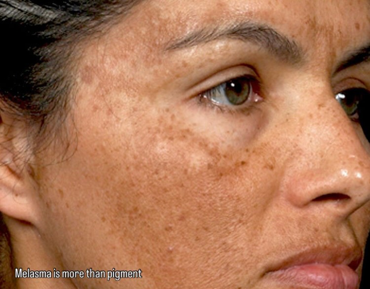 Melasma is never just surface deep…
Cutera University and the amazing Mira Kaga showcased the true complexity behind this condition — and why real results require a layered, intelligent approach.
At About Faces Noosa, we’re proud to offer advanced solutions with our Enlighten Pico Laser and XLV+ Vascular laser— combining precision, power, and skin intelligence to treat melasma the right way.
This is next-level skin technology… and I’m so excited to bring it home to you.
Ready to start your journey?
SMS 0416 999 227 to book your personalised consultation.
#aboutfacesnoosa #melasmatreatment #enlightenlaser #cuteralaser #advancedskincare skinexpert luxuryskinclinic noosaskin skinconfidence skinjourney aesthetictechnology glowingskin skinresults queenslandbusiness beautywithintegrity