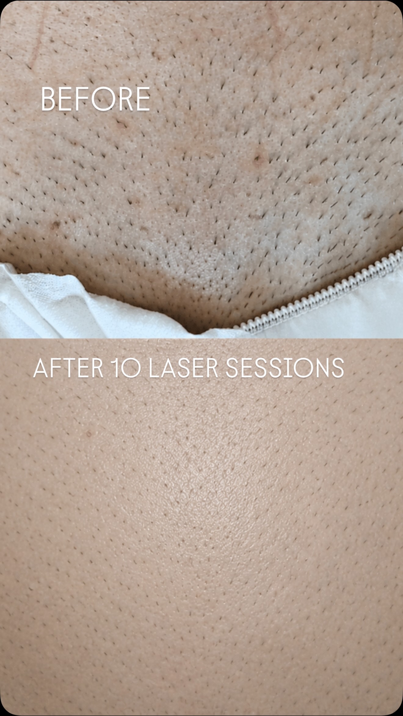 We have gone MAD for May & we are offering 40% off ALL laser courses! Grab the deal before we change our minds …
#cheltenham #gloucestershire #bathroadcheltenham #beautyinthecotswolds #laserhairremoval
