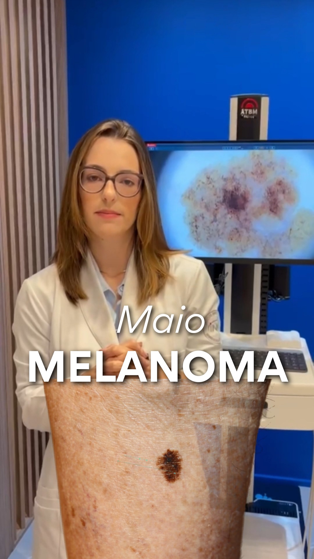Maio: mês de conscientização e combate ao melanoma.
Prevenção, diagnóstico precoce e cuidado salvam vidas.
Dra. Júlia Lóss - Dermatologia Oncológica
CRM 5201085638 RQE 34041
#melanoma #melanomaprevention #maiomelanoma #cancerdepele