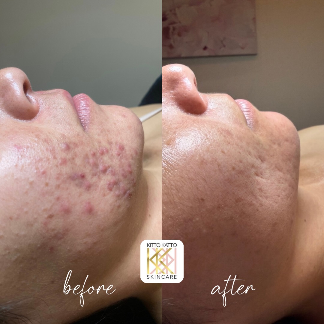 Wow! Check out this 1 year skin transformation by our esthetician Lillienne
Skin transformations take time, consistency, and guidance from your esthetician - nothing happens overnight friends ☺️
#skintransformation #denverskin #denveresthetician #esthetician #denvermedspa