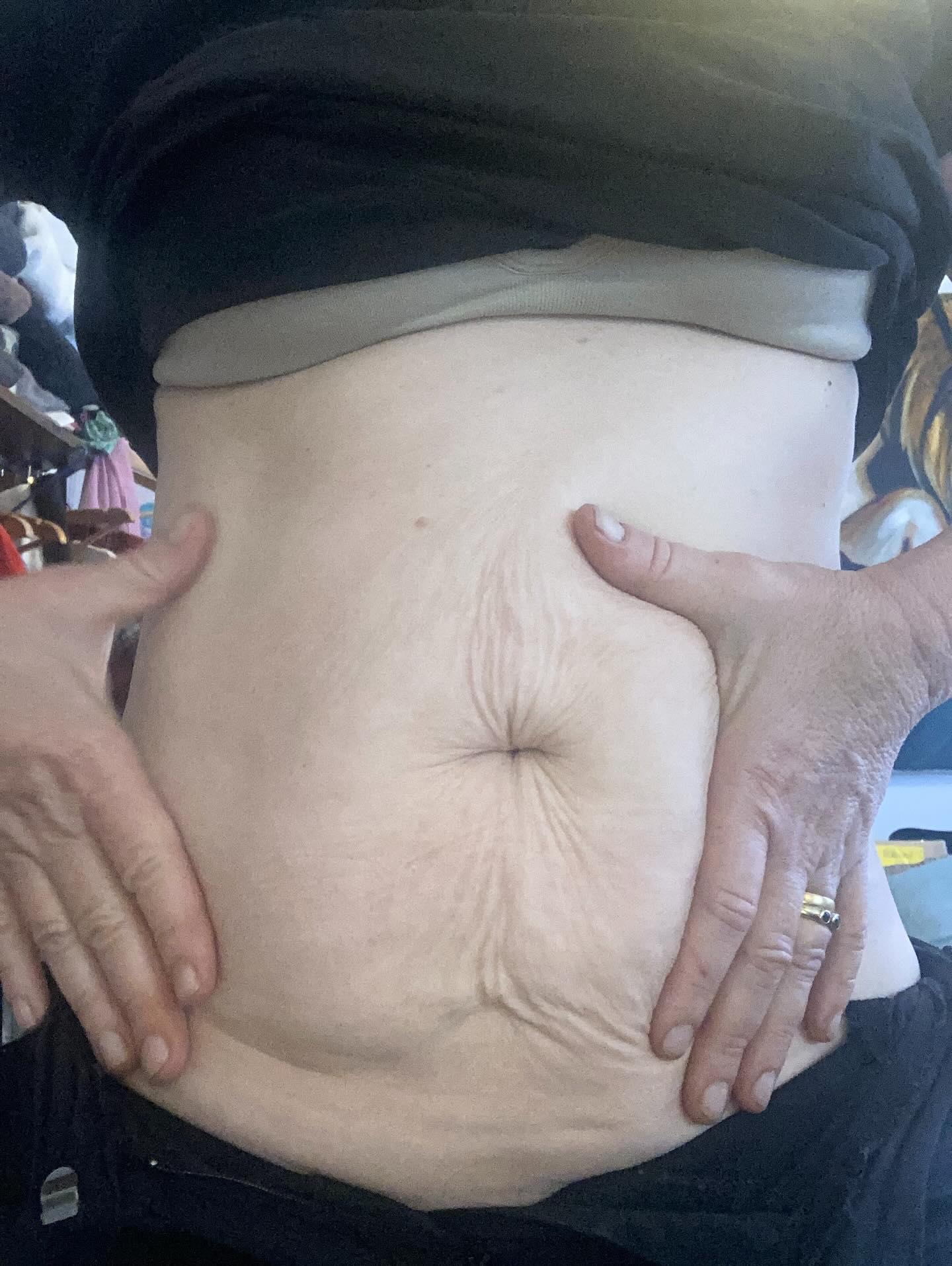 So, being very open and letting you into my personal life.
Had three children, lost 20 kilo’s, and close to 56years.
I’m working on my tummy and tightening and soften the scars of life. Being a Virgo, I earn for perfection-for me anyway and keeping my vessel as good as it gets.
Loving how the fusion plasma helps my muscles heal quicker as a masseuse and helping others.
Selling my plasma pen and going full speed with Fusion Plasma, love the benefits and who ever knows me, I always pick, younger longer, naturally