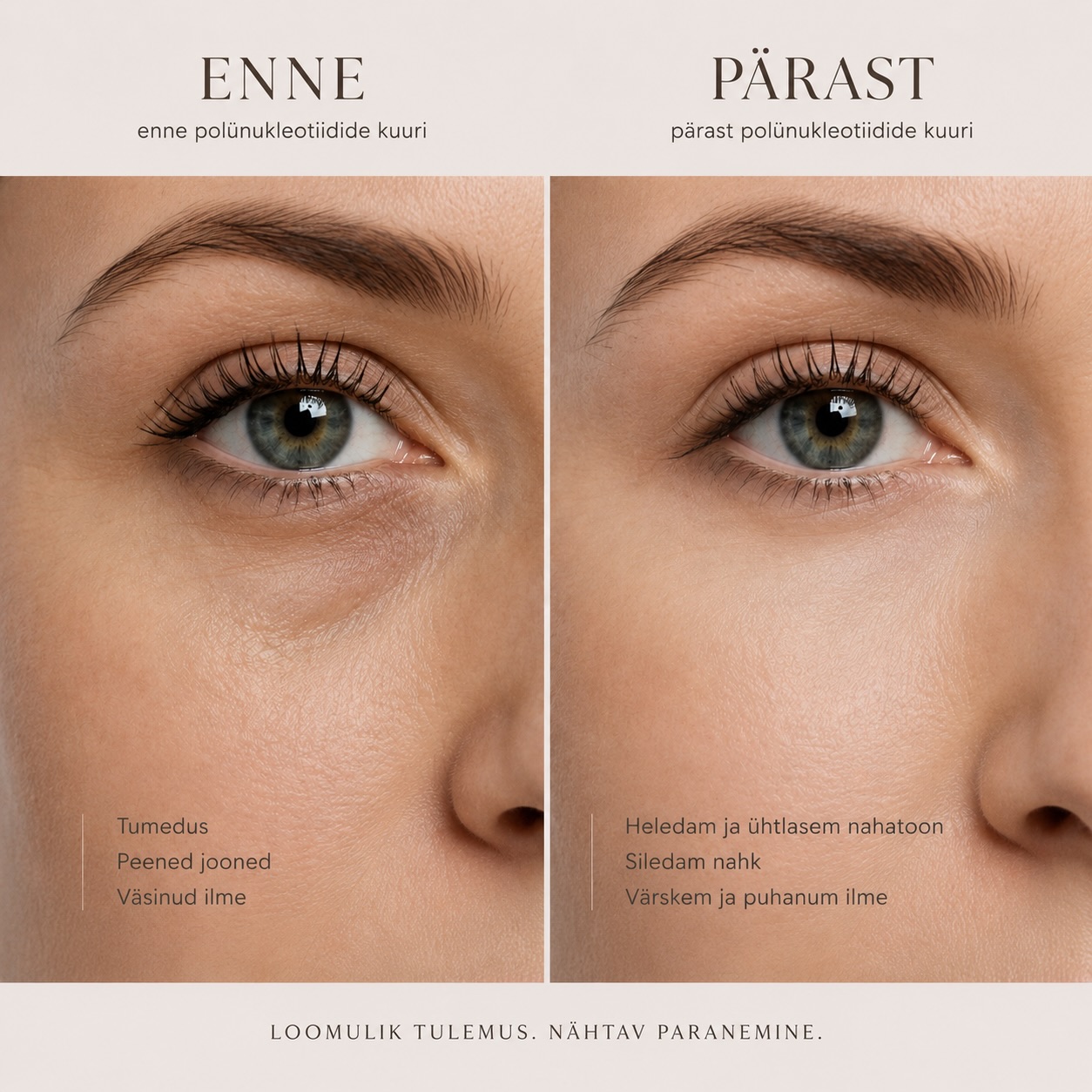 Polünukleotiidid silmaalustele ✨
Väsinud pilk, tumedamad silmaalused ja peened joonekesed võivad muuta kogu näoilme kurnatuks.
Polünukleotiidid aitavad stimuleerida naha loomulikku taastumisprotsessi, parandada naha kvaliteeti ning toetada kollageeni tootmist just õrnas silmaümbruse piirkonnas. 🤍
Tulemuseks:
- siledam ja niisutatum nahk
- värskem ja puhanum ilme
- ühtlasem nahatoon
- loomulik naha kvaliteedi paranemine
Parimad tulemused saavutatakse kuurina ning muutus toimub järk-järgult ja loomulikult.
#polünukleotiidid #silmaalused #skinbooster #aestheticmedicine #nahaabiorevitalisatsioon