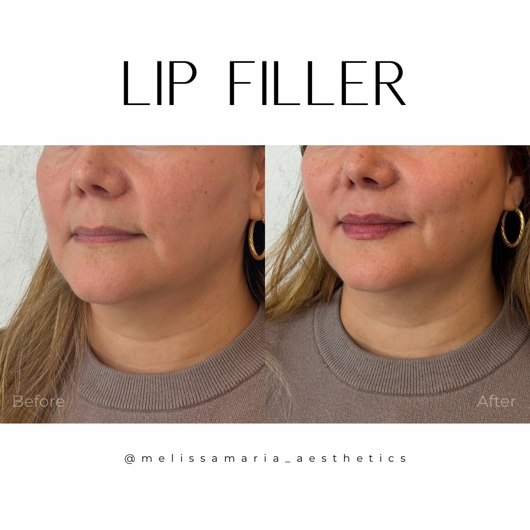 This patient drove three hours after following me for years for her custom lippies 👄
Lip filler doesn’t have to mean big. It can be a very subtle and tasteful difference. While we did not do facial balancing on this patient the amount of balance that her new lips brought to her face was amazing!
We used three different types of products in this lip. This is why we don’t charge per syringe because someone’s tissue can be very different from the tablet to the bottom lip from the middle of the whip to the more lateral portions of the lip. Everything we do at Blossüm is customizable and not a one size fits all there is no lip technique or specific lip filler that we use our selection changes based off of your anatomy and so does our technique. And that is what you’re paying for not a syringe but a customize plan carried out by your Injector.
#lipfillerraleigh #lipfillercharlotte #lipsbymeli #medsparaleigh #medspacharlotte