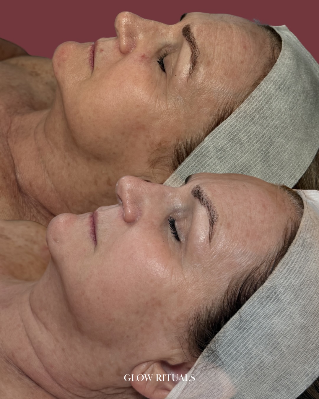 After just 2 targeted treatments, we’ve already noticed refined fine lines, a more even complexion & an overall skin radiance that speaks for itself😍
This is what a corrective skincare routine can do when working in harmony with targeted in-salon treatments.
Treatments alone can only take you so far. What truly accelerates and maintains your results is what you do at home, every morning & night🌙
Think of it this way, your in-salon treatments do the heavy lifting while your homecare keeps the momentum going between visits. Without that daily support, the skin gradually returns to its baseline.
For my wonderful client, we rebuilt her skincare routine. Incorporating these 3 main targeted products specifically for her concerns:
💛Vitamin Infusion Booster: Vitamins A, C, D & E vitamins to promote collagen production, brighten her complexion & protect the skin from ageing at a cellular level
💛Flash-White Even Skin Booster: Targets pigmentation from every angle. Prevents pigment from forming, inhibits melanin production & gentle exfoliates exisiting discolouration
💛Mineral Pro SPF: A must in every skincare routine, because UV damage undoes any treatments faster than anything else
Real skin change doesn’t happen overnight but with the right support & guidance you’ll be amazed!
If this is what 2 treatments can achieve, I cannot wait to share her results once we’ve completed her full treatment plan🥰
🤍Laura
#antiageing #sydneyskinclinic #correctiveskincare #dermapen #skinneedlingsydney