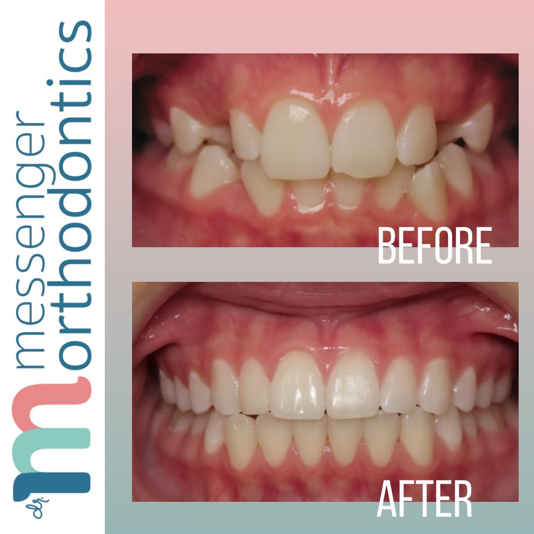 Transformation Tuesday ✨
Blocked-out canines + deep bite → balanced, full smile
Creating space, correcting bite, and finishing with a natural esthetic result.
•
•
📍 Huntington Beach | Orange County | California
☎️ (714) 500-7147
🌎 www.messenger-smiles.com
•
•
•
#HuntingtonBeachOrthodontist #DeepBiteCorrection #BlockedOutCanines #SmileTransformation #BeforeAndAfterSmile BoardCertifiedOrthodontist MessengerOrthodontics