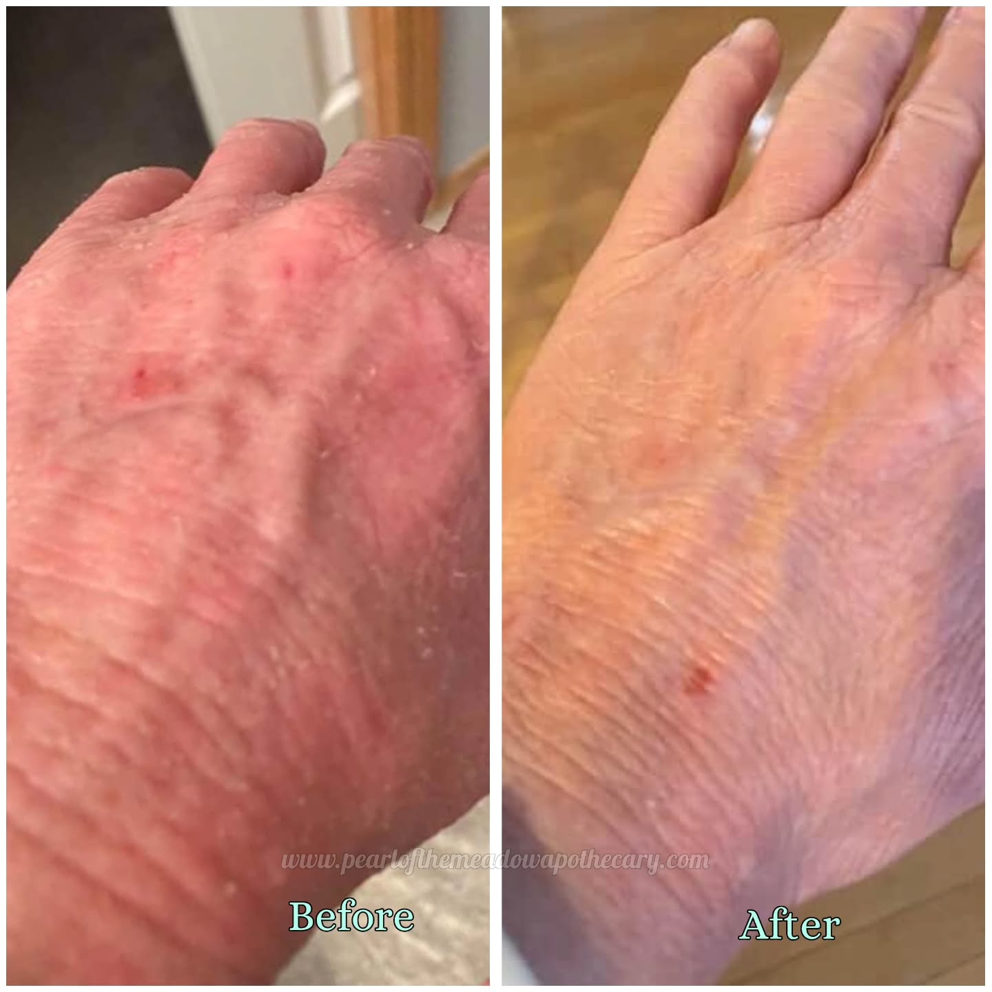 I love client testimonials. I appreciate it so much 😃
This is what our Yarrow salve can do to your irritated skin. It may be temporary but its better than synthetic toxins and chemical based balms.
Lathering expensive store factory made products can be harmful to you as it can soak into your body. Please be mindful of what it contains.
Pearl of the Meadow Yarrow Salve is just plain Herbal magick 😍 - ingredients from Mother Nature, handpoured by a human, and in small batches. And most importantly, with intention to support your healing. Concocted with infused yarrow, organic olive oil, organic coconut oil, beeswax, lavender essential oil and vitamin e. Simple but powerful.
DM to order
#herbalbeauty #achilleamillefolium #clienttestimonial❤️ #naturalskincare #herbalistmade