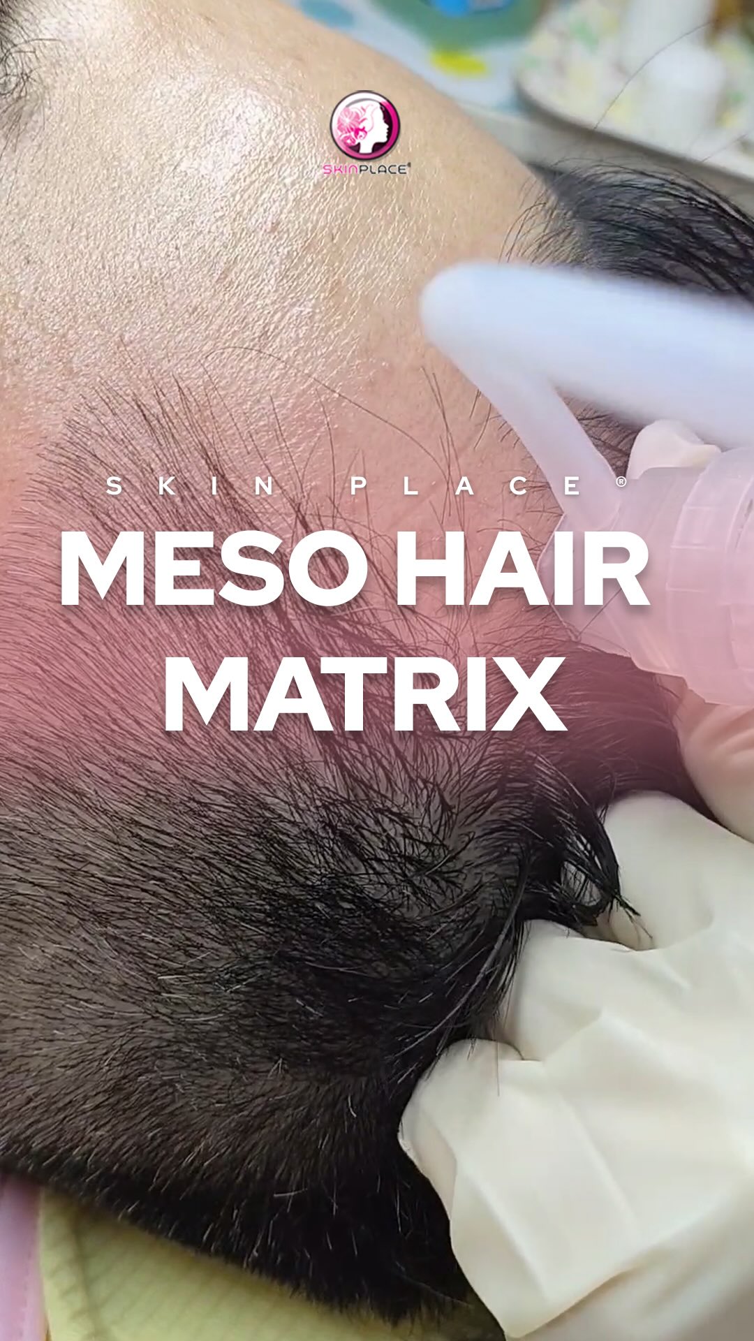 Give your hair the nourishment it deserves. ✨
Looking for a boost in hair vitality? Skin Place Meso Hair Matrix is our advanced solution for a healthier scalp and stronger-looking strands.
Why we love it:
Targeted Nutrition: Delivers essential nutrients directly where they’re needed.
Follicle Support: Designed to help hair feel thicker and more resilient.
Scalp Health: Creates the perfect environment for your hair to thrive.
Whether you’re looking to address thinning or simply want to improve your hair’s overall strength, this innovative treatment is suitable for all hair types.
Ready to transform your hair journey?
📍 Skin Place is Your Skin’s Place.
#skinplace #skinplaceph #MesoHairMatrix