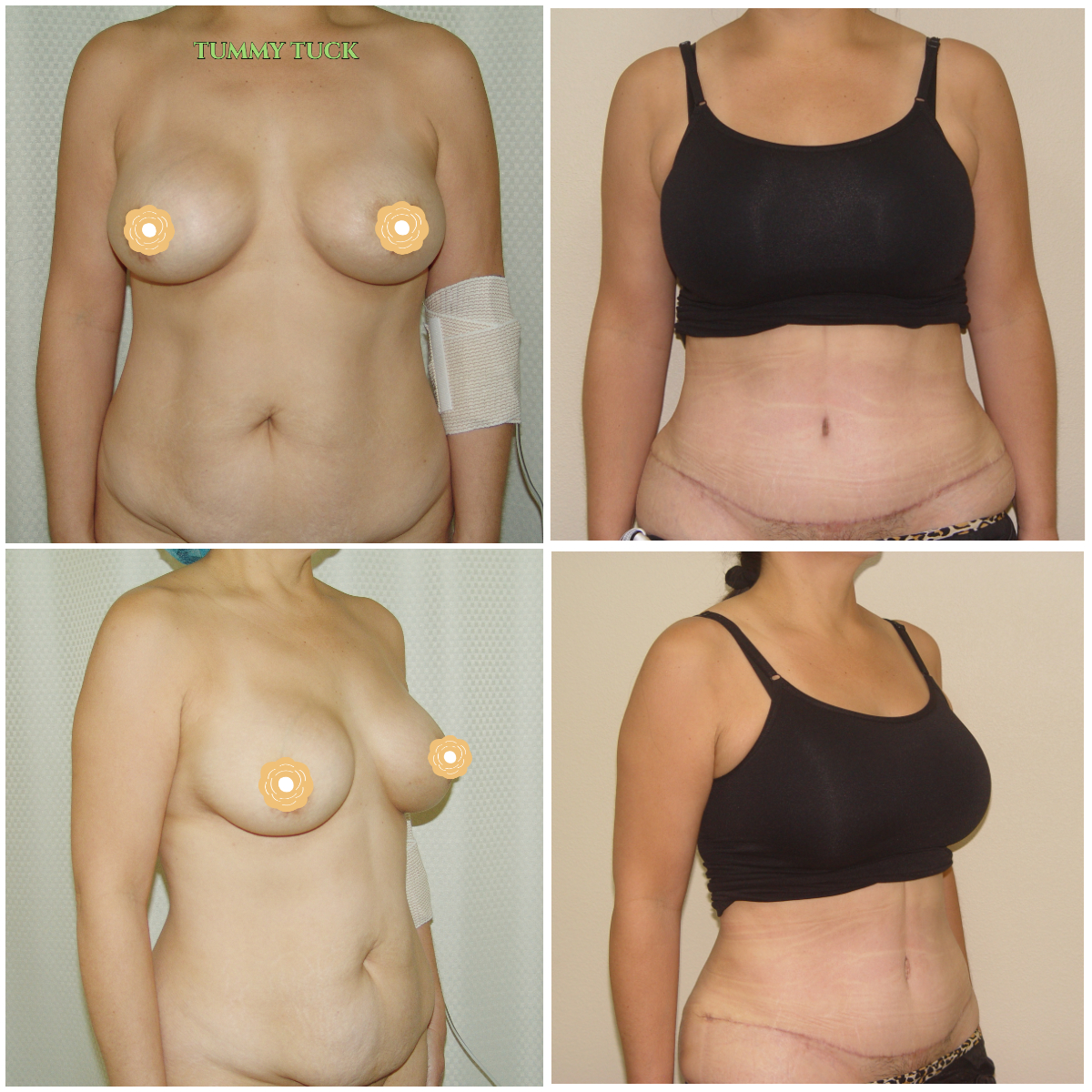 Call now for our Mother’s Day Specials! Saline Breast Aug -->$3995 Silicone Breast Aug --> $6495 Tummy Tuck starts at --> $7995. Call (714) 500-0050 #drluudoan #breastaug #salineimplants #siliconegelimplants #tummytuck #abdominoplasty