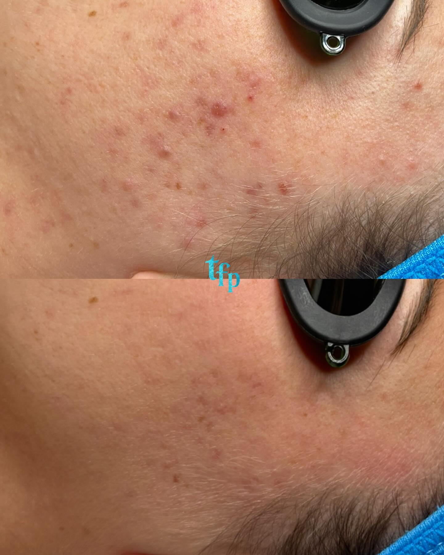 Clearing your acne naturally is possible with my biweekly Acne Bootcamp program. You can get clear skin in 3-5 months 🩵
How it works:
🪼Come in biweekly for acne facials (discounted to $109)
🪼Purchase a full customized skincare routine with me and do it morning and night at home (around $300 give or take)
🪼Switch to acne-safe makeup and laundry detergent
🪼Minimize acne triggering foods in your diet
Let’s get you clear once and for all! Book on thefaceplacemi.com ! I can’t wait to help you🌊🫶🏼