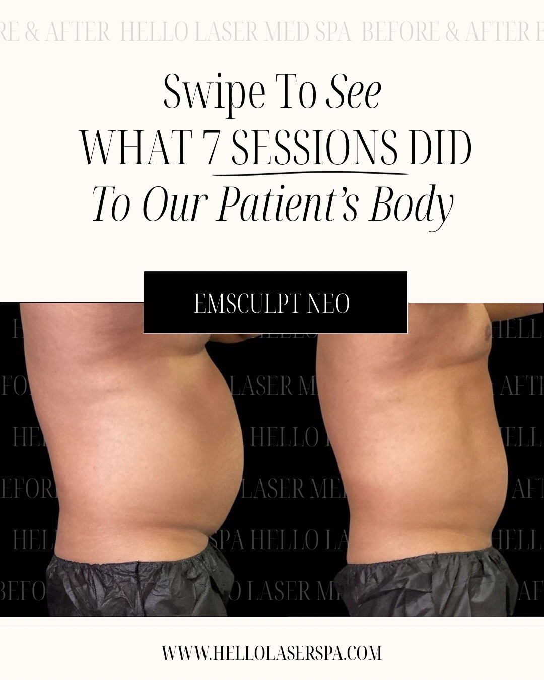 We were genuinely stunned by these results. 🔥
7 sessions in and this patient saw significant reduction in overall fat in the treated area and clear, visible muscle definition that you simply cannot fake.
This is what happens when the right technology meets consistency. EMSculpt NEO doesn’t just target fat. It simultaneously builds real muscle through 20,000 supramaximal contractions per session while radiofrequency energy permanently destroys fat cells. No surgery. No downtime. No question about whether it works.
We let the results do the talking.
📞 Call us today for special pricing on EMSculpt NEO
480-905-3080
🔗 Book your complimentary consultation online, link in bio
📍 Transforming Scottsdale, Phoenix & Tempe bodies one session at a time
#EMSculptNEO #ScottsdaleMedSpa #PhoenixBodyContouring #NonInvasiveBodyContouring #RealResults