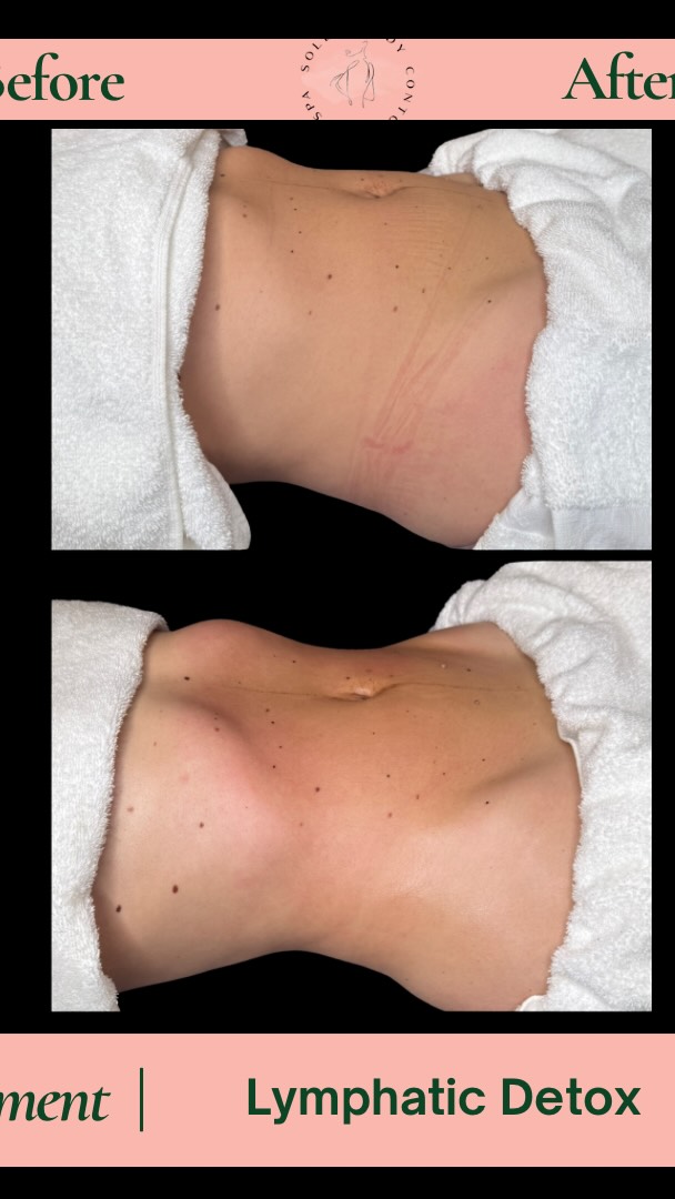 Not all “fat” is actually fat 👀
Some of what you’re seeing could be retained fluid, inflammation, or poor lymph flow.
When your body starts draining properly and inflammation goes down, you may notice:
• Less bloating
• A slimmer look
• More energy
• Feeling lighter
Sometimes your body just needs support not more restriction
✨ Book your complimentary wellness consultation to learn more.
#LymphaticHealth #WellnessGlow #BodyBalance #SelfCare