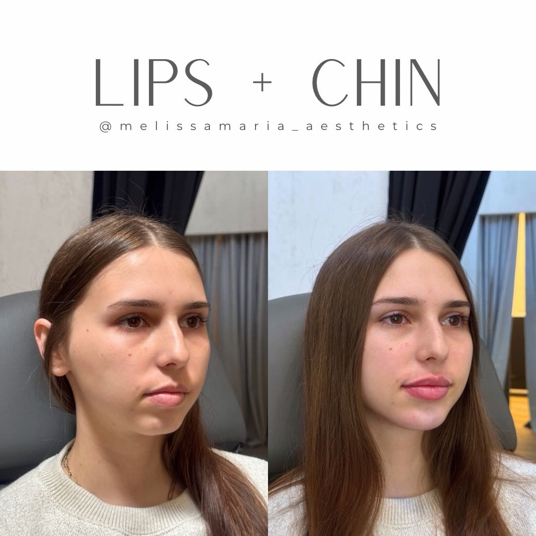 Ok this may be my favorite one this year!
Her facial balancing plan didn’t consist of much because she is stunning ✨
We opted for lips and chin to balance her lower face and enhance her profile and I am obsessed 😍 #lipfillerRaleigh #chinfillerraleigh #facialbalancingraleigh #facialbalancingcharlotte #facialbalancinggreensboro