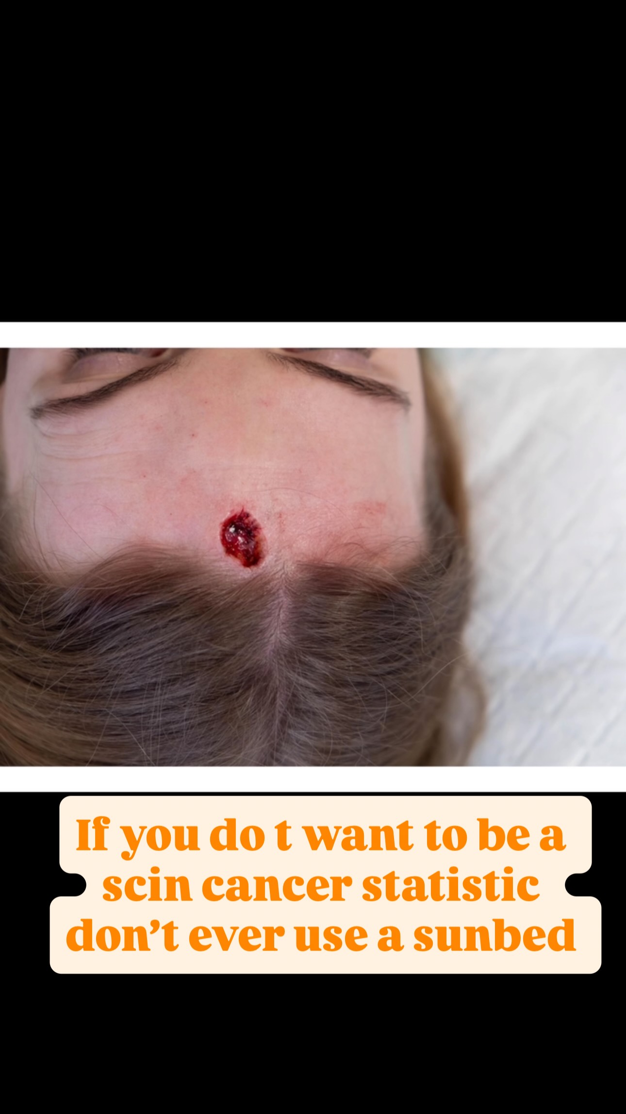 It’s Skin Cancer Awareness Month.
The first image above is me on a sunbed years ago.
The following images show the Basal Cell Carcinoma (BCC) that later formed on my forehead, the wound after MOHS surgery, and the scar that followed.
What’s important to understand is that at the point this skin cancer appeared, I had not used a sunbed for over 10 years.
The damage had already been done.
As a teenager and young adult, I was completely misinformed. Because I have very pale skin, I was told that using sunbeds before holidays would “prepare” my skin, help me “build melanin”, and stop me from burning.
These were things I genuinely believed at the time.
I thought I was helping my skin — not harming it.
This was before I properly moved into the skin industry and before I truly understood the science and risks behind UV exposure.
What I now know is this:
There is no safe amount of sunbed use.
Not occasionally.
Not before a holiday.
Not “just for a base tan”.
Not even once.
Even after stopping sunbeds completely, I could not undo the damage that had already taken place within my skin.
So I’m sharing this because awareness matters.
If this post stops even one person from starting sunbeds, or makes someone rethink going back on them, then it’s worth sharing.
If you have used a sunbed even once before the age of 35, you increase your risk of melanoma — the deadliest form of skin cancer — by 75%.
Please protect your skin.
Your tan is never worth your health.
#SkinCancerAwarenessMonth #SkinCancerAwareness #SunbedAwareness #NoSafeTan #MelanomaAwareness BCC BasalCellCarcinoma SkinHealth SkinClinic MohsSurgery SPF UVSafety EarlyDetection ThePatchTheory SkinCancerPrevention TanningBeds SunbedDamage ProtectYourSkin SkinEducation TheExpertSkinClinic