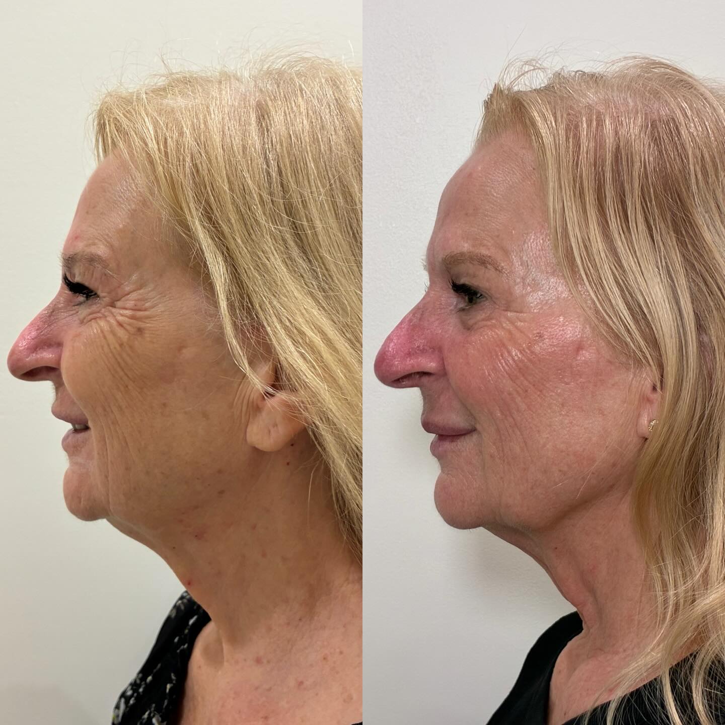 OPUS RF + Aspect Dr home care results
After 2 treatments, our clients skin is looking smoother in texture, firmer and more refined overall.
Photo 3 shows the immediate effect of just 1 Uniface treatment to the face and neck for that quick lift and plump. Perfect for keeping the collagen stimulation going between Opus treatments or pre event as there is no downtime.
Book in for a consultation with our Skin Therapist to discuss your customised Opus plan
#radiofrequency #skintightening #skinresurfacing #opusplasma