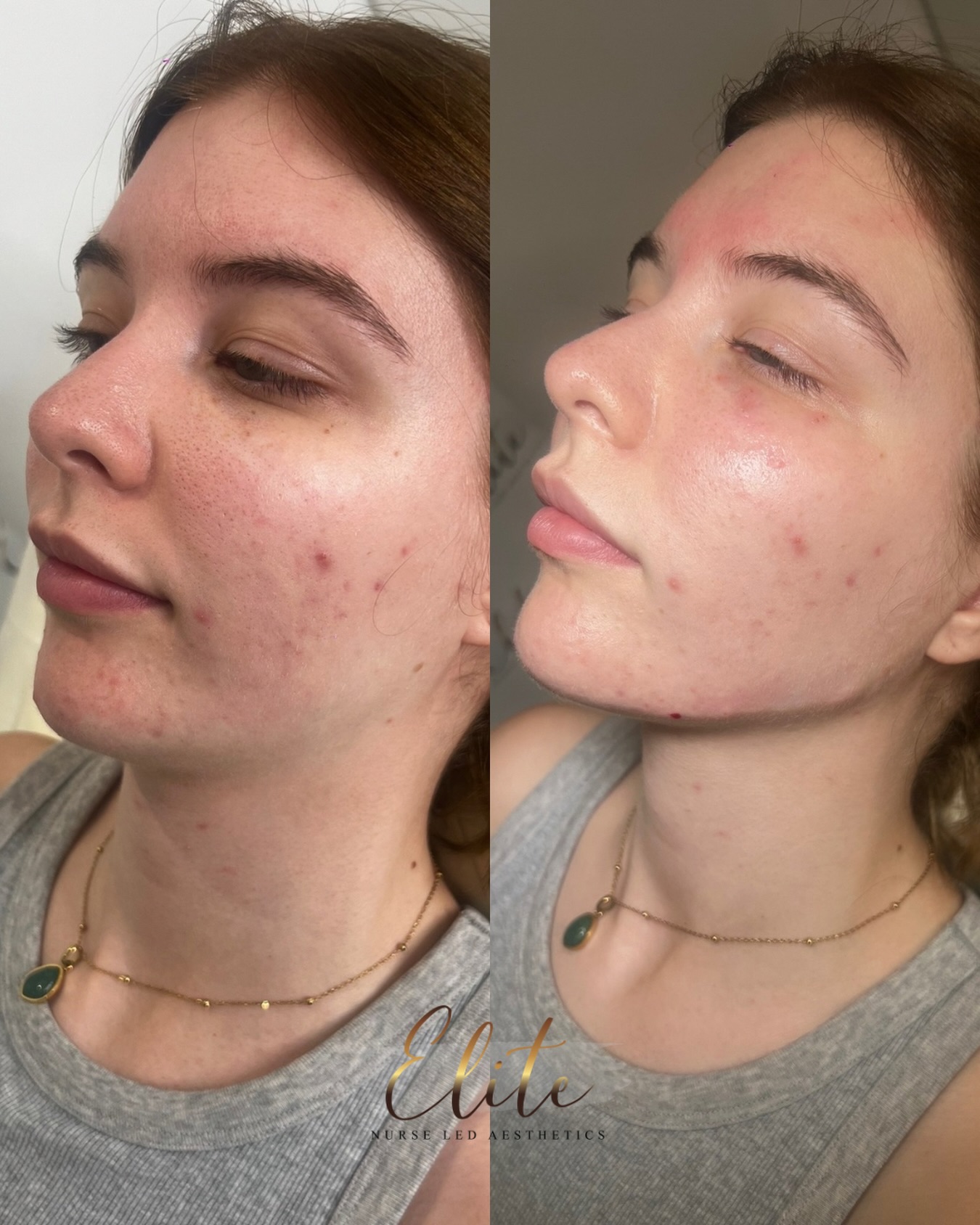 💎 Before & After – Jawline Enhancement 💎
A defined jawline can transform the entire face – adding structure, balance, and a youthful contour.
With expertly placed dermal filler, we can:
✨ Sculpt and sharpen the jawline
✨ Improve facial symmetry
✨ Restore definition lost over time
🩺 Performed by Nurse Katie at Elite Nurse Led Aesthetics – always using premium products and advanced techniques for natural-looking results.
📅 Book your consultation to see how jawline enhancement can elevate your profile.
📩 Call or WhatsApp 07596 389971
📍 Elite Nurse Led Aesthetics – Batley, West Yorkshire
#JawlineEnhancement #BeforeAndAfter #EliteNurseLedAesthetics #FacialSculpting #BatleyAesthetics DermalFiller DefinedJawline SafeAesthetics