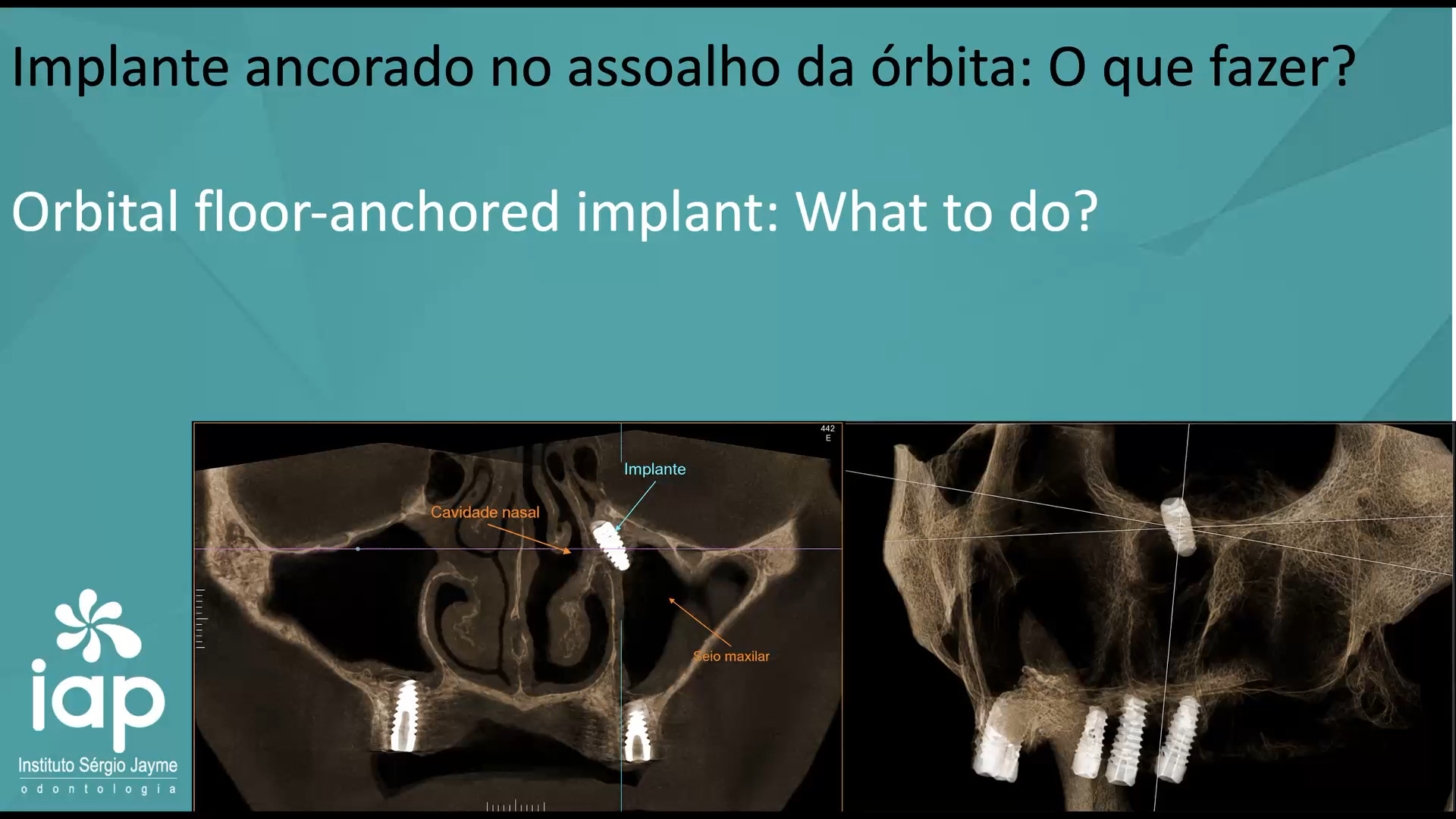 Implante ancorado no assoalho da órbita: O que fazer?
Orbital floor-anchored implant: What to do?
Um implante “ancorado” ou migrado para próximo do assoalho da órbita é uma complicação séria e não deve ser apenas acompanhado sem investigação adequada.
A conduta depende principalmente de:
• posição exata do implante no CBCT;
• presença de penetração orbital;
• sintomas oculares;
• estabilidade do implante;
• presença de sinusite/infecção.
Pela literatura, implantes deslocados para o seio maxilar e região do assoalho orbitário geralmente necessitam remoção cirúrgica precoce devido ao risco de sinusite, celulite orbitária e lesão muscular ocular.
Conduta prática normalmente considerada:
1. Solicitar/avaliar CBCT completo em cortes axial, coronal e sagital.
2. Avaliar sintomas:
o diplopia;
o dor orbitária;
o edema periorbitário;
o sinusite;
o parestesia infraorbital.
3. Planejamento da remoção – Possibilidades:
o acesso endoscópico nasal;
o acesso lateral do seio;
o combinação das técnicas, dependendo da localização.
Se o implante realmente perfurou o assoalho orbital, o risco aumenta para:
• diplopia permanente;
• lesão de músculos extraoculares;
• hematoma orbitário;
• restrição motora ocular.
A cirurgia de retirada do implante foi executada no IAP-Sérgio Jayme
Dr. Sérgio Jayme
Av. Paulista, 91 Cj 402 Tel (11)5572-1283 / Cel e WhatsApp (11)94888-2000 CEP:01311-000 São Paulo-SP
Av. Rubem Berta, 1461 Tel (11)2276-2217 / Cel e WhatsApp (11)98383-3941
CEP: 04074-010 São Paulo-SP
#implante #curso #rog #cytoplast #enxertoosseo #enxerto #iap #rog #regeneracaoosseaguiada #enxerto #enxertoosseo#sergiojayme #sergiojaime #cienciaemvideo #osseodensificacao #seiomaxilar #enxertoseiomaxilar #implacil #nobelbiocare #welfare #sinuslift #arteriasinusal #cirurgiaavancada #implantenointeriordoseiomaxilar