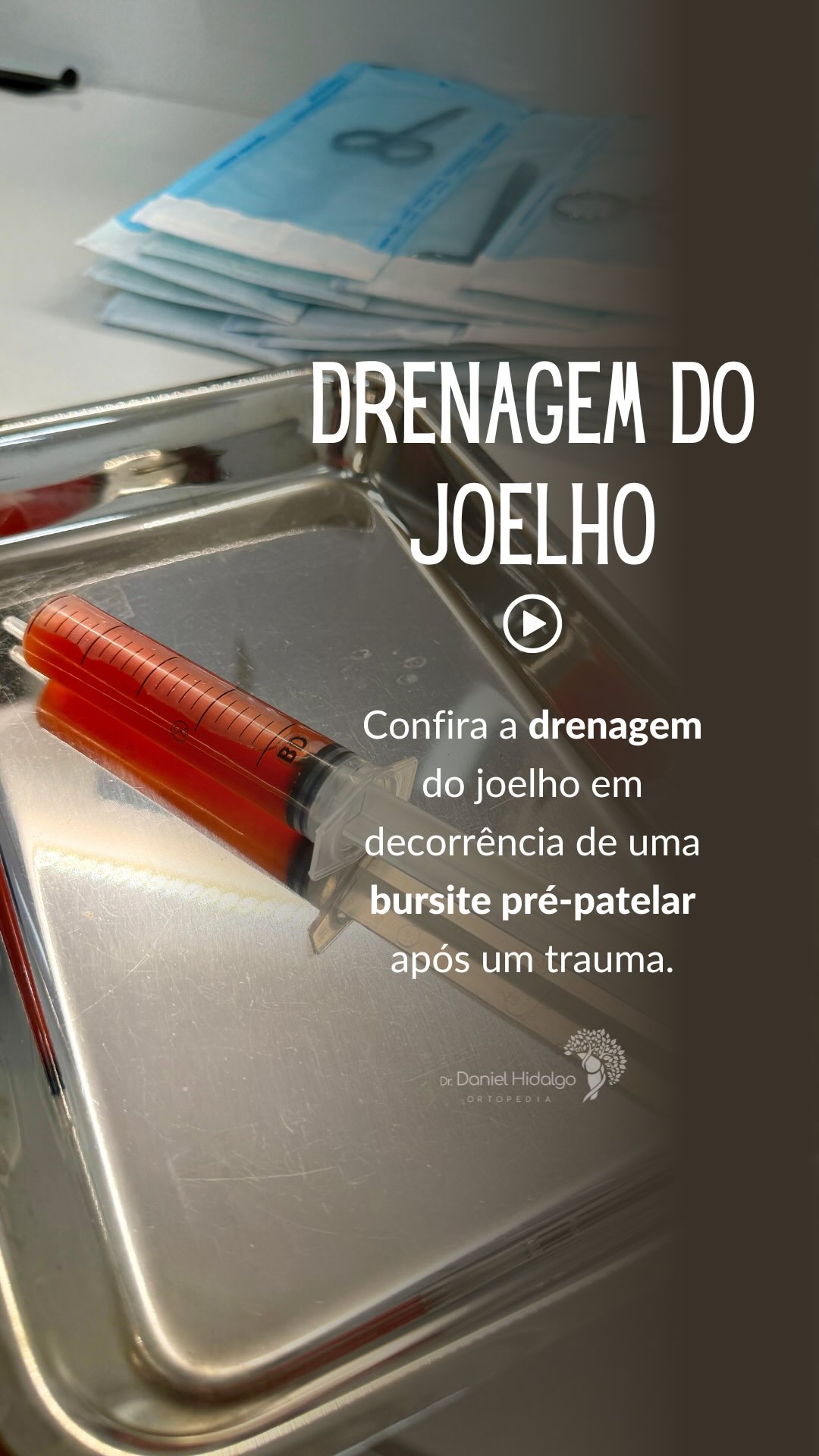 Bastidores de um procedimento 💉realizado para tratar uma bursite pré-patelar pós-traumática, condição que pode causar aumento de volume, dor e limitação após impactos diretos na parte da frente do joelho.
Neste caso, foi realizada a drenagem da bursa inflamada para aliviar os sintomas e acelerar a recuperação do paciente.
⚠️ Nem todo joelho inchado após trauma é “apenas uma pancada”. A avaliação adequada faz diferença no diagnóstico e no tratamento.
Dr. Daniel Hidalgo - Médico Ortopedista
CRM-SP 137.057 | RQE 41.112
Membro da Sociedade Brasileira de Ortopedia e Traumatologia (SBOT)
Membro da Sociedade Brasileira de Cirurgia do Joelho (SBCJ)
Membro da Sociedade Médica Brasileira de Tratamento por Ondas de Choque (SMBTOC)
#Ortopedia #Joelho #Bursite #BursitePrePatelar #traumatologia