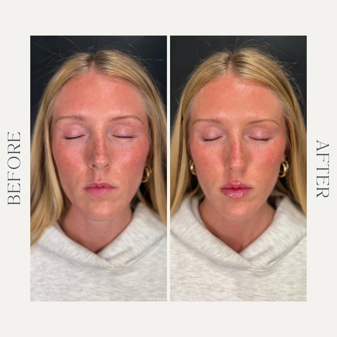 You would be so surprised what just a tiny bit of filler can do 👄💉
Results by: @alisha_childress_lla
Alisha created this beautiful results with only .5 of Volbella by @juvederm
#lipfiller #juvederm #medspalife