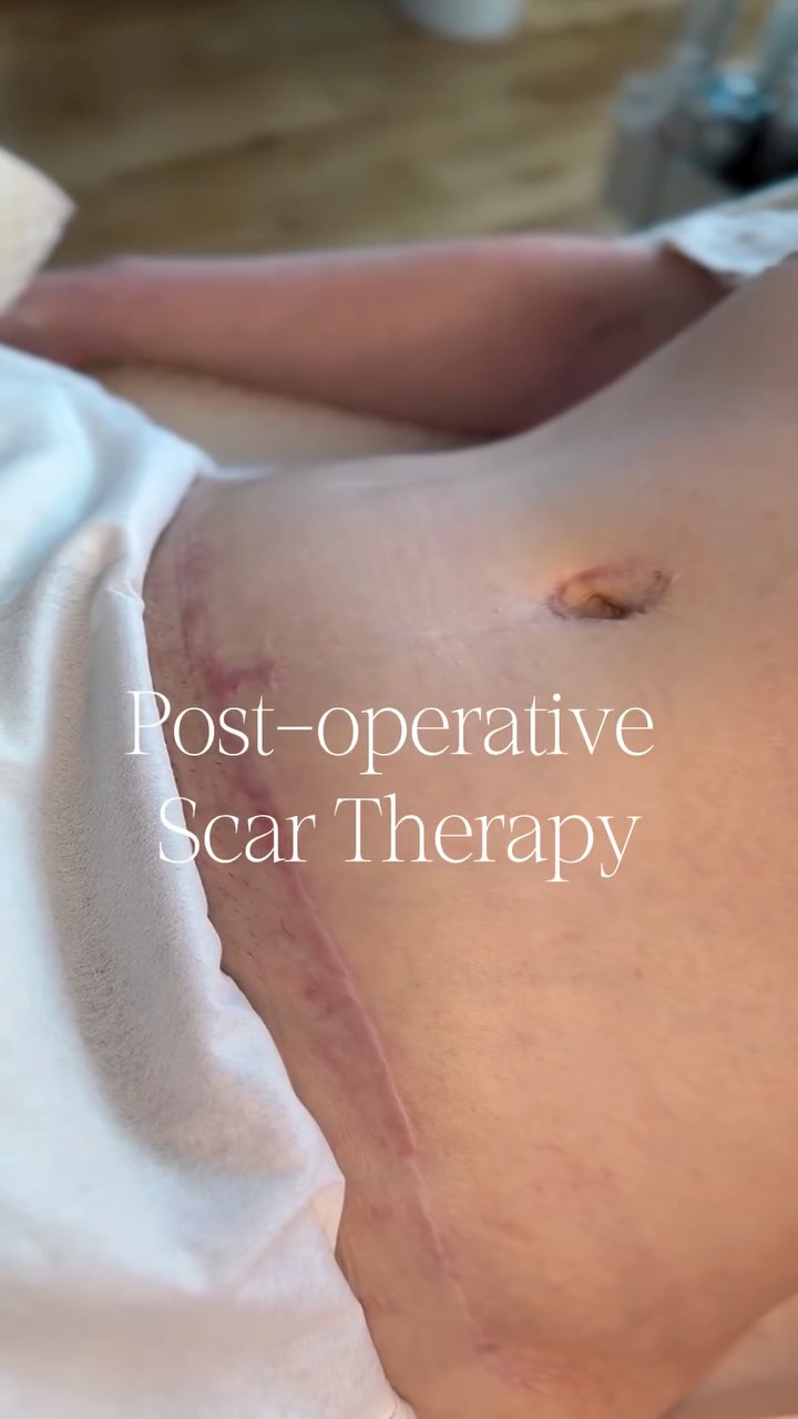 Optimising Scar Healing After Surgery.
Post-operative scar therapy plays an important role in the recovery process by supporting tissue healing, improving skin mobility, and helping reduce the appearance of scarring over time.
Through targeted treatment techniques, we aim to assist with:
• Scar softening and remodeling
• Reduction in adhesions and fibrosis
• Improved circulation and lymphatic flow
• Enhanced comfort and mobility during recovery
Early and consistent scar management can contribute to optimal healing outcomes and long-term skin health.
For post-operative care enquiries or to schedule a consultation, please contact us directly.
#PostOperativeCare #ScarTherapy #ScarManagement #PostSurgicalRecovery #lymphaticdrainage