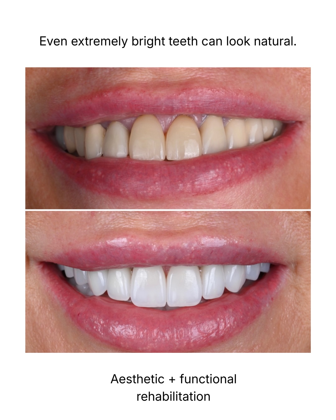 One of the most common misconceptions in cosmetic dentistry is that very bright teeth automatically look artificial.
In reality, naturalness is determined far more by proportion, facial integration, texture, smile dynamics, and overall harmony than by shade alone.
This particular case also required full-mouth rehabilitation to improve function and occlusal stability in addition to aesthetics.
Every smile design should be individualized.
There is no universal formula or “one-size-fits-all” solution.
A successful result depends on understanding what the patient wishes to achieve, establishing a clear vision together, and translating that vision into a carefully planned and predictable treatment process.
The technical execution matters enormously — but so do restraint, planning, and communication.
#CosmeticDentistry #SmileDesign #FullMouthRehabilitation #Prosthodontics #DentalAesthetics
