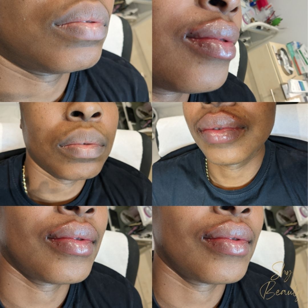 Ready for the ultimate confidence boost? 👄
Check out this stunning before & after! We are absolutely obsessed with these results. Our goal was all about adding natural volume and a beautifully defined shape that enhances her unique features. No "overdone" look here: just soft, hydrated, and radiant lips.
If you’ve been thinking about refreshing your look, HMB Salon is the go-to spot in Chingford for expert aesthetic treatments. Our experienced team ensures you feel comfortable and empowered throughout the whole process.
Regular Price: £195
Special Offer: £150
(Special offer for a limited time only!)
Tap the link in our bio to book your consultation and let’s create your dream look! 💖
#HMBSalon #ChingfordBeauty #LipFiller #NaturalAesthetics