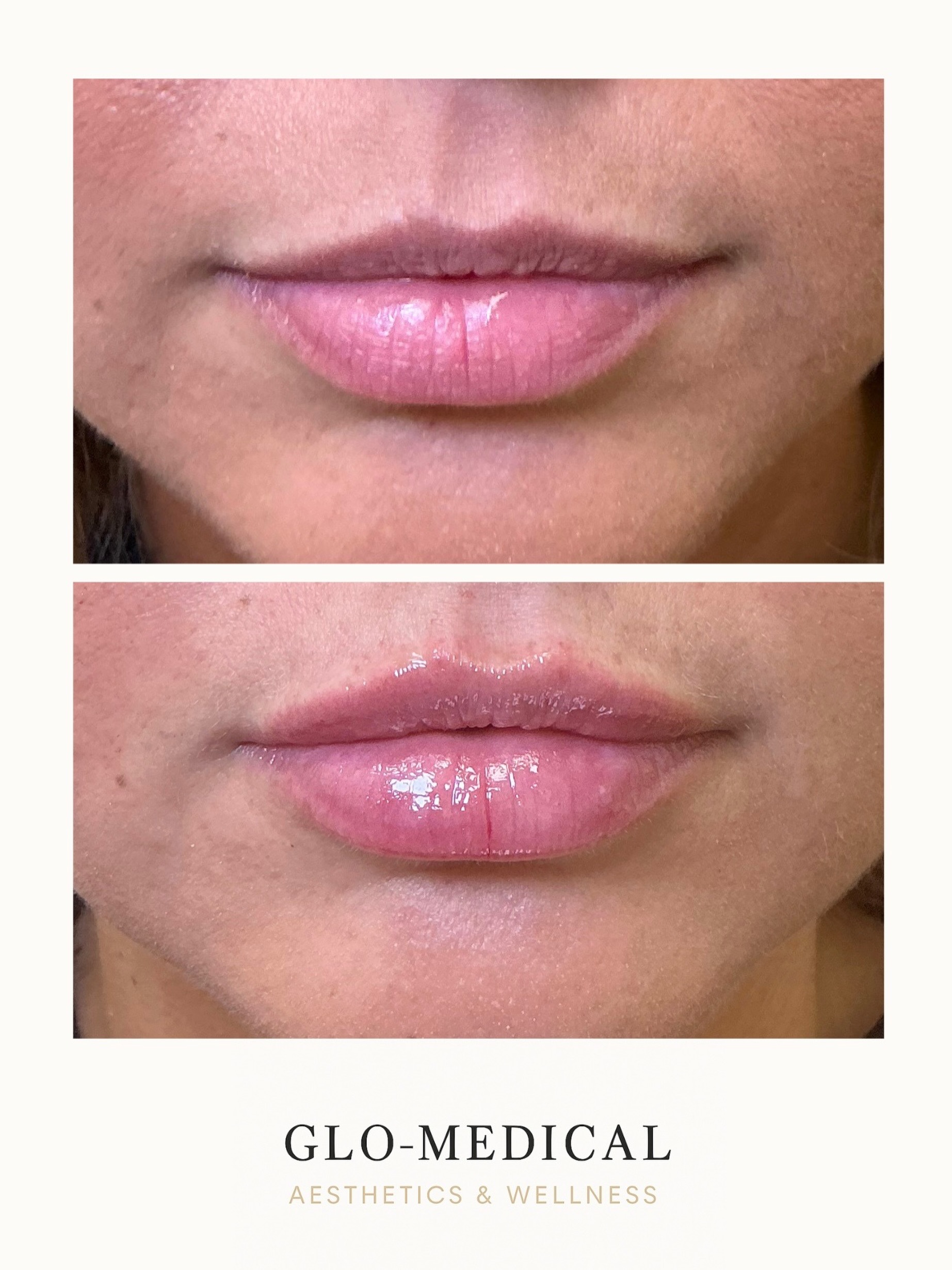 Natural lip enhancement for the “your lips but better” look. 💋