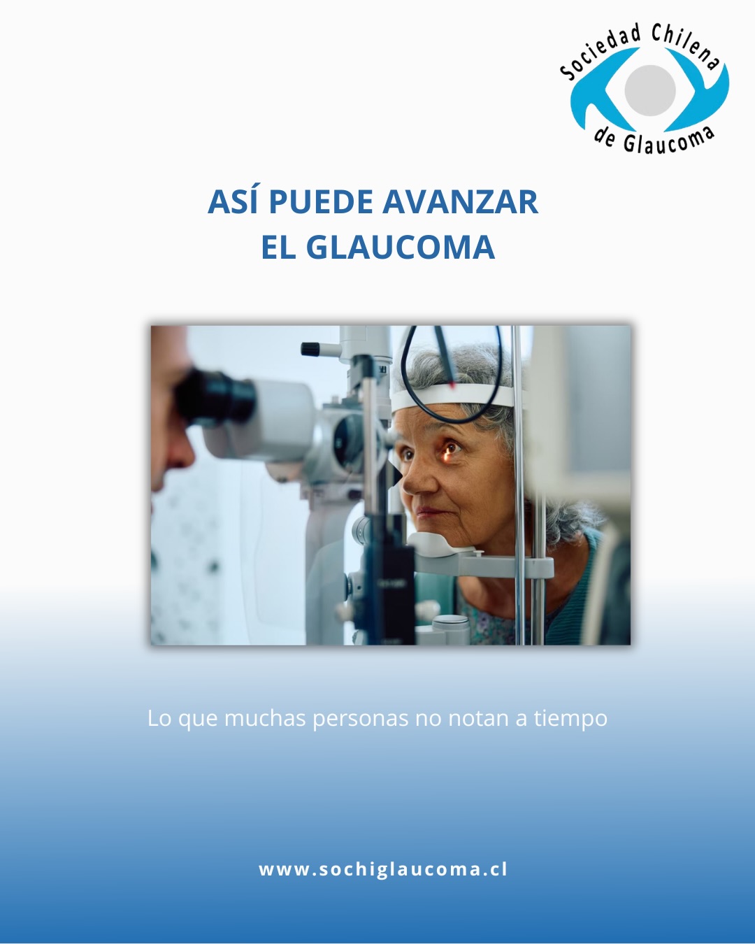 🔹 El glaucoma puede avanzar sin síntomas evidentes
En etapas tempranas, la pérdida visual suele afectar la visión periférica, por lo que muchas personas no notan los cambios a tiempo.
Con el avance de la enfermedad, actividades cotidianas como caminar o reconocer obstáculos pueden hacerse más difíciles.
👉 Desliza este carrusel y conoce cómo puede avanzar el glaucoma.
Guarda este post y compártelo para ayudarnos a que más personas puedan crear conciencia sobre esta enfermedad tan silenciosa
⚠️ IMPÓRTATE: Esta información es solo orientativa y no constituye ni reemplaza una consulta médica.
Ante dudas, consulta siempre con tu médico especialista.
Para más información visita www.sochiglaucoma.cl