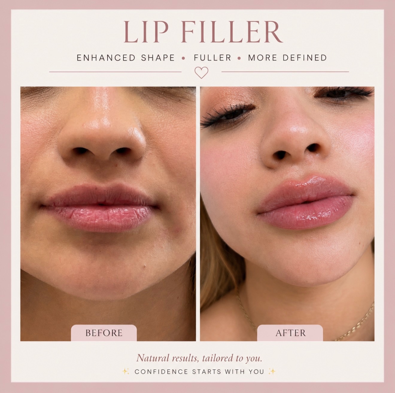 Fuller. More defined. Completely you. ✨
Lip filler isn’t about changing who you are it’s about enhancing what you already have! 🩷 Our natural-looking lip filler adds shape, volume, and definition while keeping YOUR unique beauty front and center.
💉 What to expect:
✔️ Quick, in-office treatment
✔️ Minimal downtime
✔️ Results you’ll love immediately
Ready for your dream lips? Book your consultation today, link in bio! 🔗
#primefaithaesthetics #lewisvilletx #lewisvilletexas #dfwmedspa #dfwaesthetics