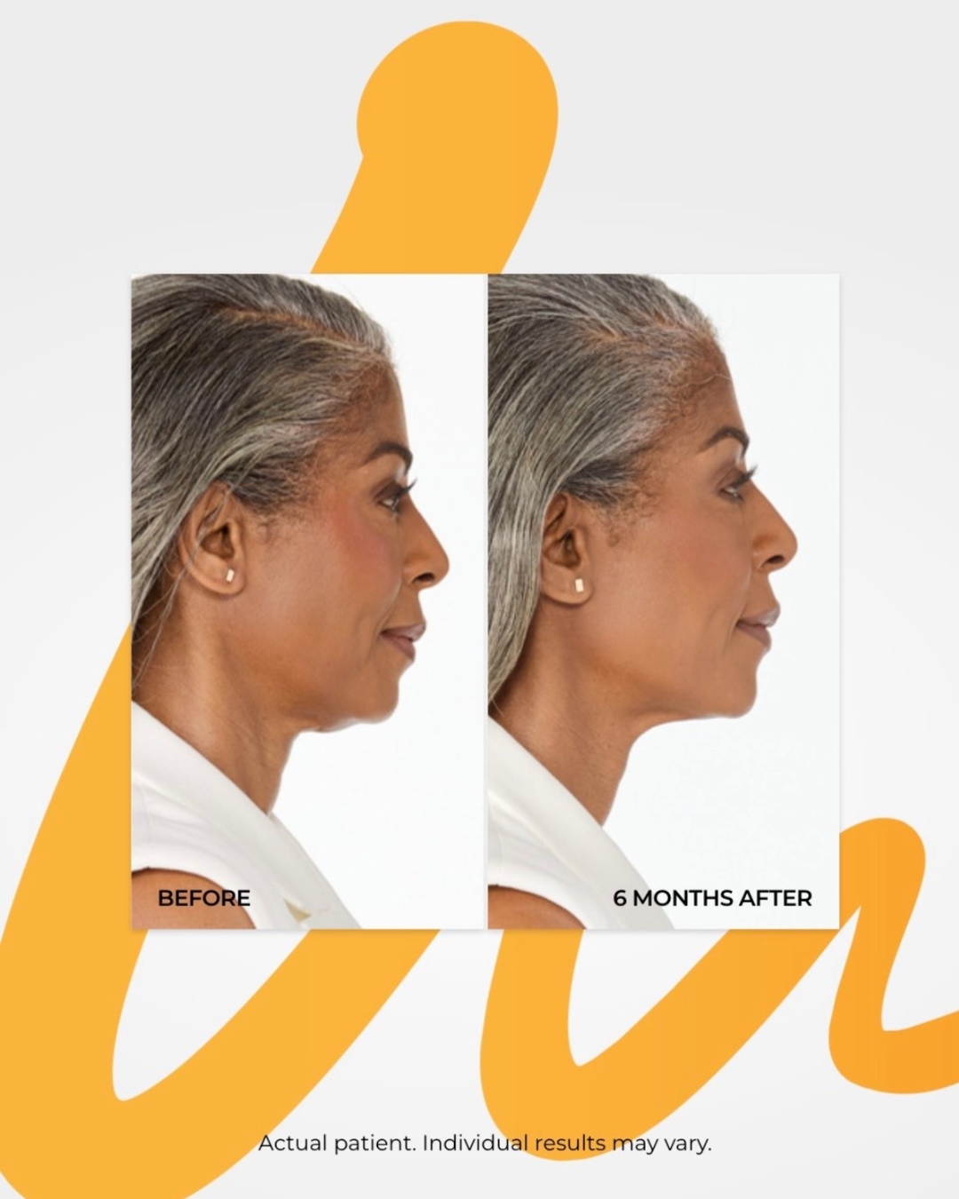 These before & after results showcase the power of Ultherapy: a non-invasive treatment that uses ultrasound energy to stimulate your body’s natural collagen production deep beneath the skin.
Over time, patients may notice a lifted appearance in the brows, jawline, neck, and décolleté with firmer, tighter-looking skin and no surgery or downtime required.
Results develop gradually as new collagen forms, creating a subtle and natural-looking rejuvenation 🌿
Call 520-618-0232 to schedule your consultation today.
#ReNew360 #TucsonArizona #Ultherapy