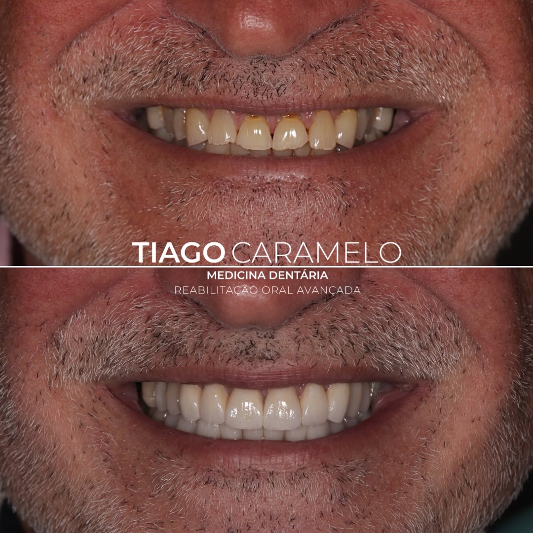 O desgaste dentário severo associado ao bruxismo pode comprometer não apenas a estética do sorriso, mas também a função, a oclusão e a estabilidade do sistema estomatognático.
Neste caso clínico, realizei uma reabilitação oral adesiva recorrendo a facetas cerâmicas, coroas e overlays, com o objetivo de restabelecer a anatomia dentária perdida, recuperar a dimensão funcional e devolver equilíbrio oclusal e estética ao sorriso.
Através de uma abordagem personalizada e minimamente invasiva, foi possível reconstruir forma, função e naturalidade, respeitando sempre os princípios biomecânicos e funcionais da reabilitação oral moderna.
Mais do que reabilitar dentes, é importante reabilitar função, conforto e confiança.
Trabalho laboratorial realizado por @deniseoliveira2238
—————————————————————————————
Severe tooth wear associated with bruxism can compromise not only smile aesthetics, but also function, occlusion, and the overall stability of the stomatognathic system.
In this clinical case, I performed an adhesive full-mouth rehabilitation using ceramic veneers, crowns, and overlays, with the aim of restoring lost dental anatomy, recovering functional dimension, and re-establishing occlusal balance and smile aesthetics.
Through a personalized and minimally invasive approach, it was possible to rebuild form, function, and naturality, while always respecting the biomechanical and functional principles of modern oral rehabilitation.
More than rehabilitating teeth, it is essential to rehabilitate function, comfort, and confidence.
Labwork by @deniseoliveira2238
#oralrehabilitation #adhesivedentistry #bruxism #veneers #crowns