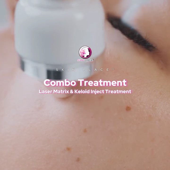 Take control of your skin with our Combo Scar Treatment! 🧬✨
We combine the power of Laser Matrix and Keloid Injections for a comprehensive approach to scar management. Here’s how it works:
1️⃣ Flatten & Soften: Specifically targets raised keloids for a smoother surface.
2️⃣ Resurface: Laser Matrix minimizes roughness and refines texture.
3️⃣ Even Tone: Reduces dark pigmentation around the scar area.
4️⃣ Long-term Control: Injections help prevent the keloid from returning.
5️⃣ No Surgery: A safe, minimally invasive alternative to surgical removal.
Ready to start your journey to smoother skin? Send us a message! 💌
📍 Skin Place: Your Skin’s Place.
✨ See comment section for more details! ✨
#SkinPlace #KeloidTreatment #LaserMatrix #ScarRemoval #SkinCareExpert #NonSurgical