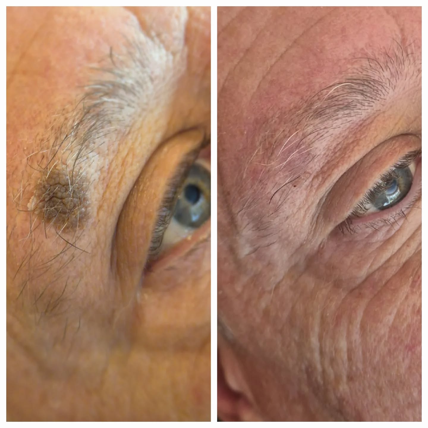 A small treatment can make such a big difference to someone’s confidence.
This gentleman came to feeling self-conscious about a mole under his eyebrow that had bothered him for years. We treated the area with cryotherapy, a quick and minimally invasive treatment designed to safely target superficial skin lesions.
Treatment was straightforward with minimal downtime, and he is already feeling so much more confident.
Sometimes it is not about changing how someone looks, it is about helping them feel more comfortable in themselves again.
Please note: all lesions are assessed prior to treatment and any suspicious lesions are always referred appropriately before cosmetic removal.