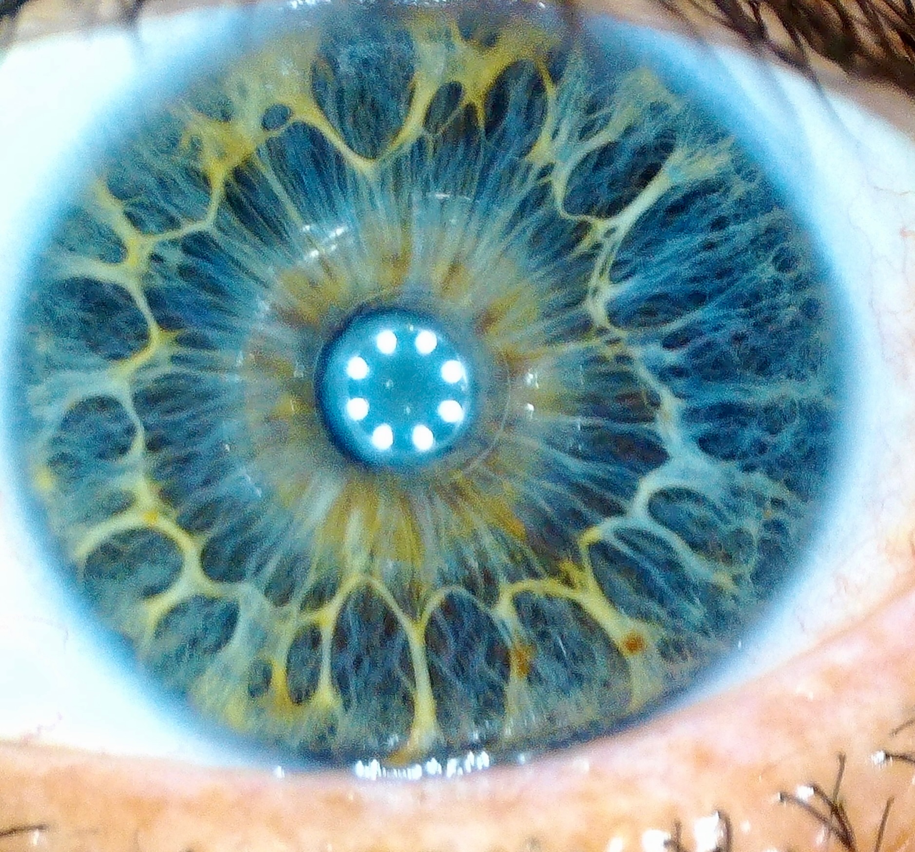 One of my favourite parts of a consult is when I pull out the iriscope and I get to look into a persons eye…the patterns, colours, fibres, textures…never cease to amaze me. Every eye is truly remarkable. Often I get asked “will my eye show you what’s wrong with me?” Here’s what I want you to know…iridology is not a diagnostic tool. I’m not looking into your eyes and diagnosing disease. That’s not how this works and honestly those kinds of claims does the modality a disservice.
What I’m doing is reading your constitution. I’m looking at structural signs that tell me about your body’s innate strengths, where it might be under strain, and where I need to dig deeper.
Contraction furrows (those concentric ring-like lines in these photos) tell me a lot about how your nervous system holds tension. I see them constantly and they almost always match what someone is telling me about their stress and energy.
Radial furrows radiate out from the pupil and can point toward areas where absorption or elimination might need support.
One thing people are always surprised by is how much digestive information shows up. The collarette sits around the pupil zone and represents the gut boundary. Changes in its shape and tone tell me a lot about how digestion is coping, and it often lines up with what a client describes around bloating or gut sensitivity.
Lymphatic tophi are small cotton-like deposits in the outer iris zones that can indicate the lymphatic system is under load. Not a diagnosis, just a sign the body’s clearance pathways need support.
Psoric spots work similarly. These darker pigmented spots give me clues about where tissue or organ function might be under strain. Not “you have X” but “this area needs attention.”
I use integrated iridology so I’m also looking at pupil dynamics, scleral signs, and structural features. It’s one tool alongside tongue and pulse, case history, pathology, and HRV. No single assessment tells the full story but together they tell me exactly where to focus.
Much love, Rach xx