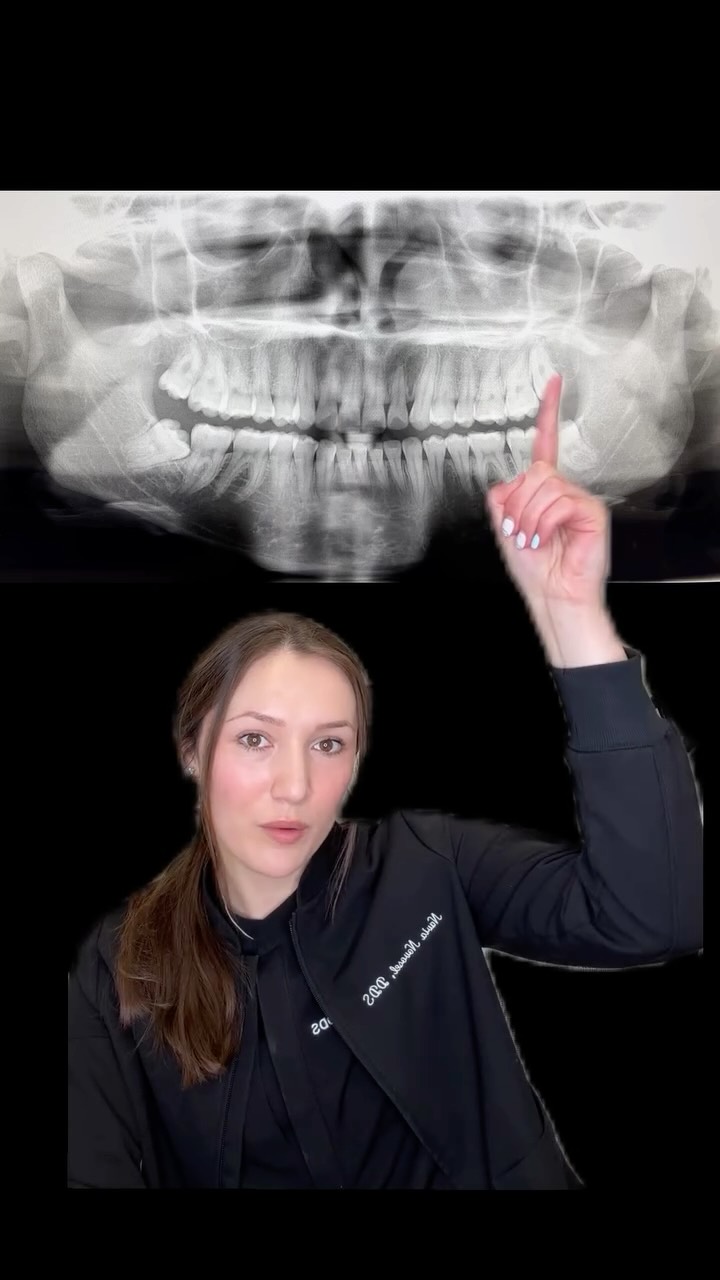 Pain in your jaw? Your wisdom teeth might be the culprit 🦷⚡️
Dr. Novosel breaks down a real patient case...horizontally impacted lower wisdom teeth, cavities on the uppers, and one clean solution: all four out!
If your wisdom teeth have been giving you trouble, come in for a consult at Brushery. We’ll walk you through everything👏
#wisdomteeth #wisdomtoothremoval #dentist #dentalcare