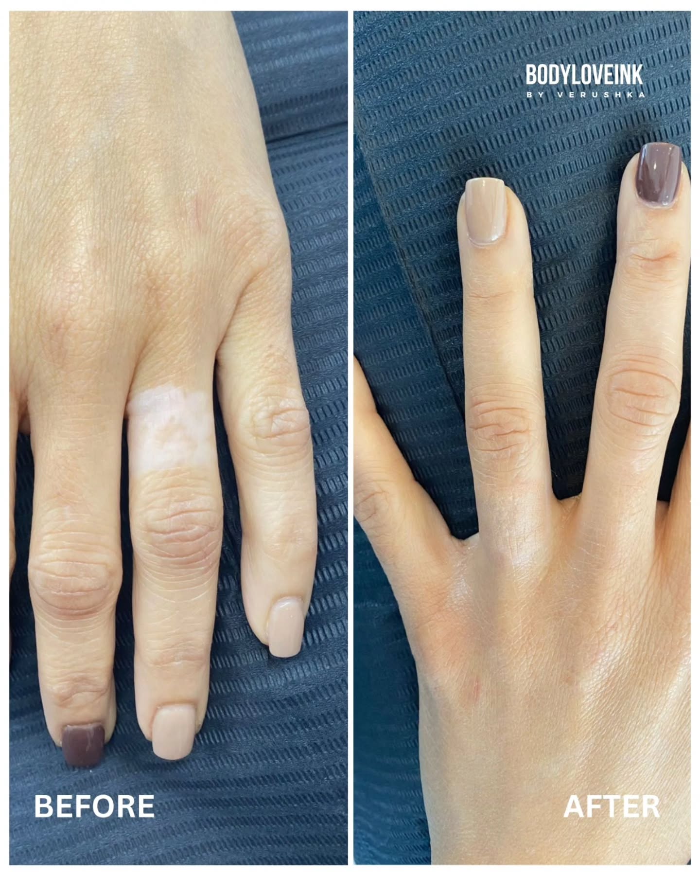 This finger is from a laser tattoo removal that left the client void of colour in the skin.
Stay tuned for the progress.
DM us for inquiries
#Bodyloveink
#scarcamouflage
#lasertattooremoval
#ifixscars
#medicalandcosmetictattoo