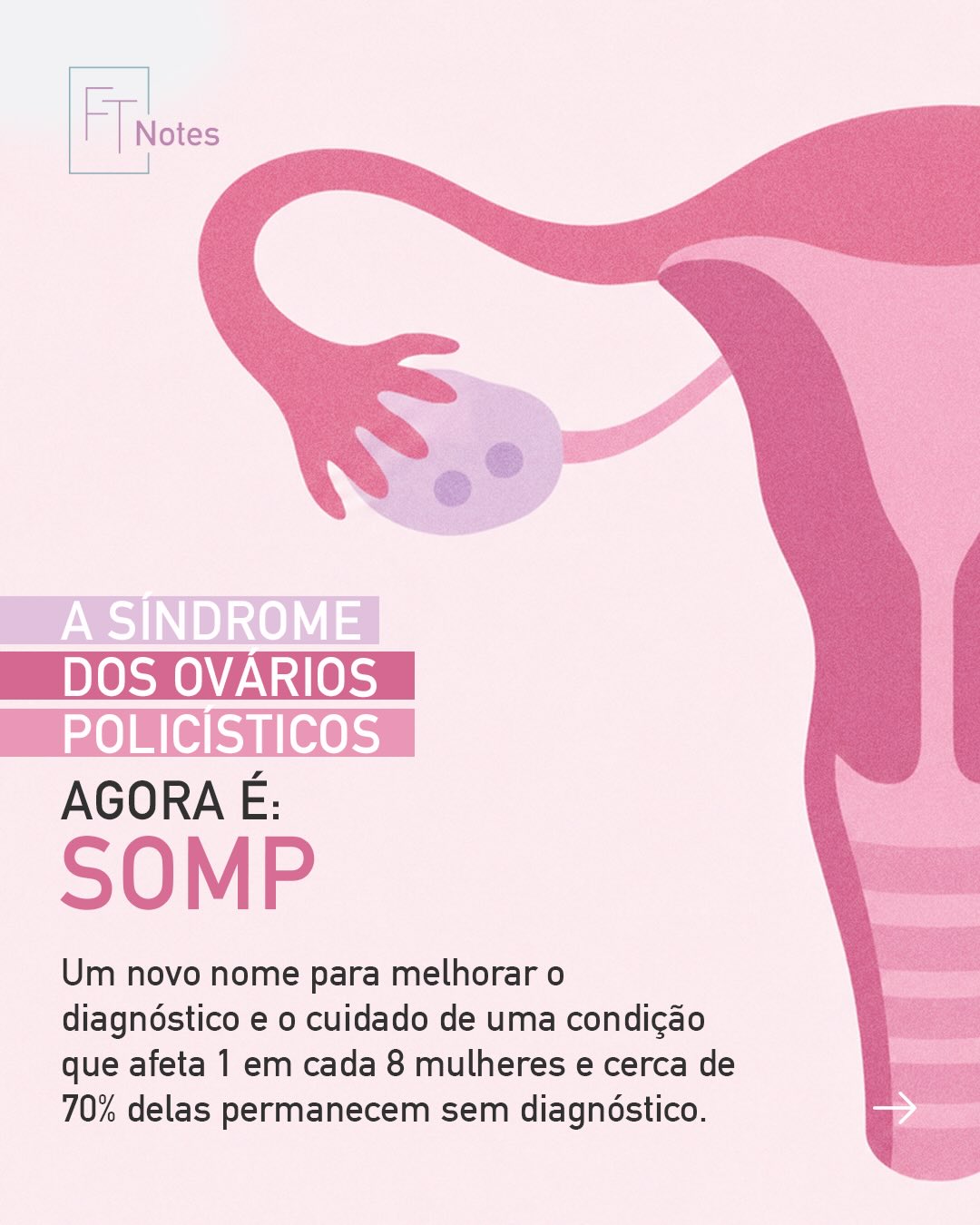 Você já sabia que a SOP agora passa a ser chamada de SOMP — Síndrome Ovariana Metabólica Poliendócrina?
A mudança reflete um avanço importante na compreensão da condição. No carrossel, explico o que motivou essa redefinição e o que ela muda na prática clínica. Arraste para o lado para conferir 📲