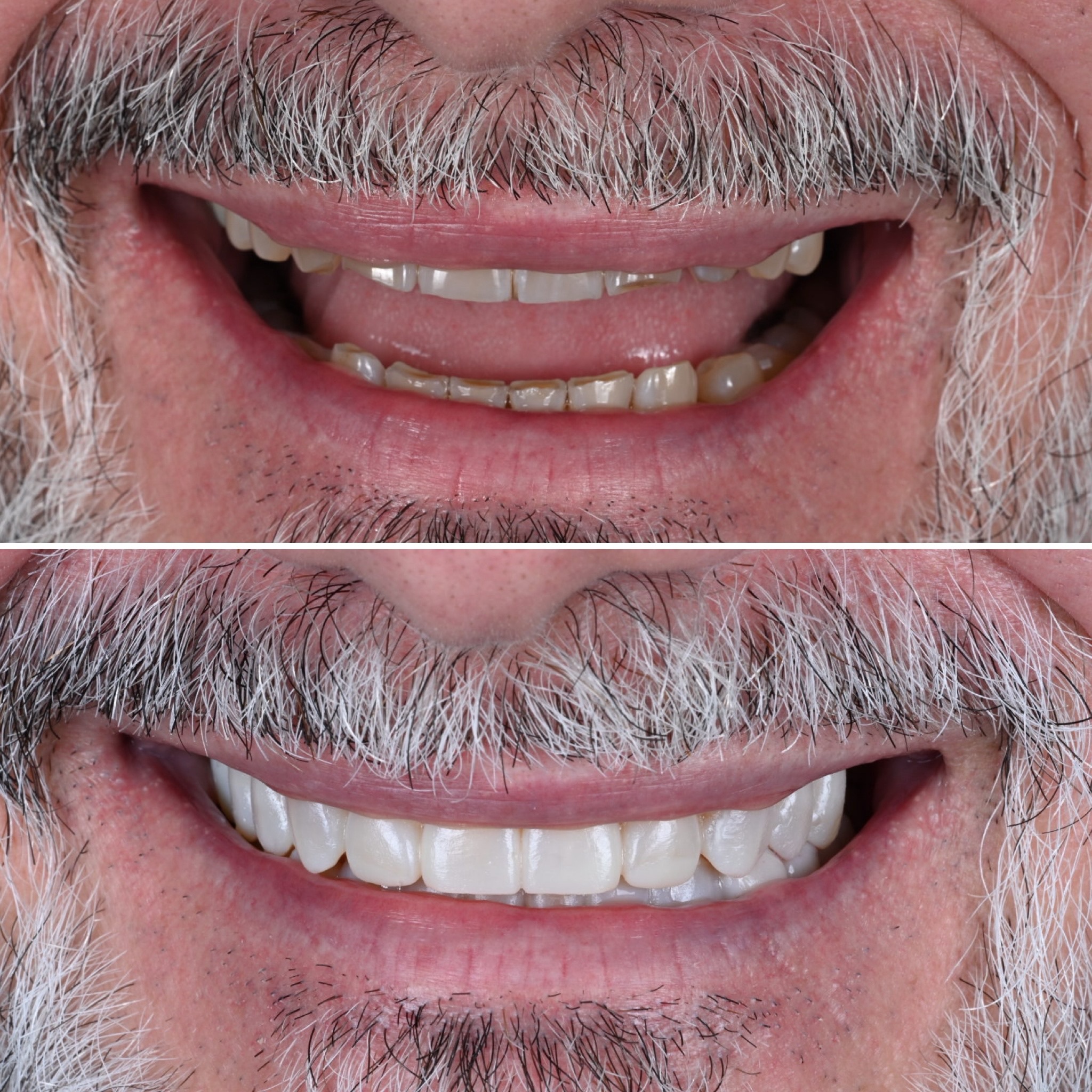 A worn dentition is rarely only an aesthetic issue.
In many cases, it is closely linked to functional instability, loss of support, and progressive changes in the bite over time.
This case involved a complex full-mouth rehabilitation to correct a posterior open bite, restore the worn dentition, and reestablish functional harmony and stability.
Beyond the functional improvement, one of the most striking aspects was the rejuvenating effect on the overall smile and facial appearance — something that is often underestimated in dentistry.
When tooth wear, bite collapse, and altered proportions are restored thoughtfully, the impact extends far beyond the teeth themselves.
Support, balance, smile dynamics, and facial integration can change significantly while still maintaining a natural appearance.
Comprehensive rehabilitation cases require careful planning, precise execution, and a deep understanding of both function and aesthetics.
The objective is not simply to create a “beautiful smile,” but to restore comfort, stability, longevity, and harmony as a whole.
#FullMouthRehabilitation #Prosthodontics #Occlusion #SmileDesign #AestheticDentistry