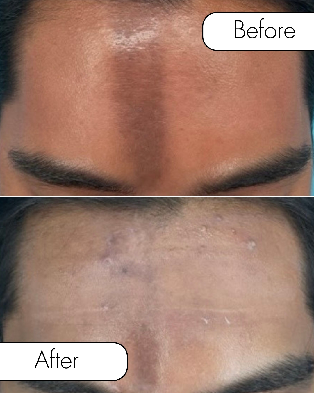 Skin transformation in progress ➡️
These before & after results showcase the power of Microneedling with Exosomes, a treatment designed to improve skin texture, tone, hydration, and overall radiance while supporting the skin’s natural healing process.
Microneedling creates controlled microchannels in the skin, while exosomes help enhance recovery and rejuvenation for smoother, healthier-looking skin over time.
The result? Brighter, firmer, more refreshed skin with a natural glow.
Call 520-618-0232 to schedule your consultation today.
#ReNew360 #TucsonArizona #Microneedling