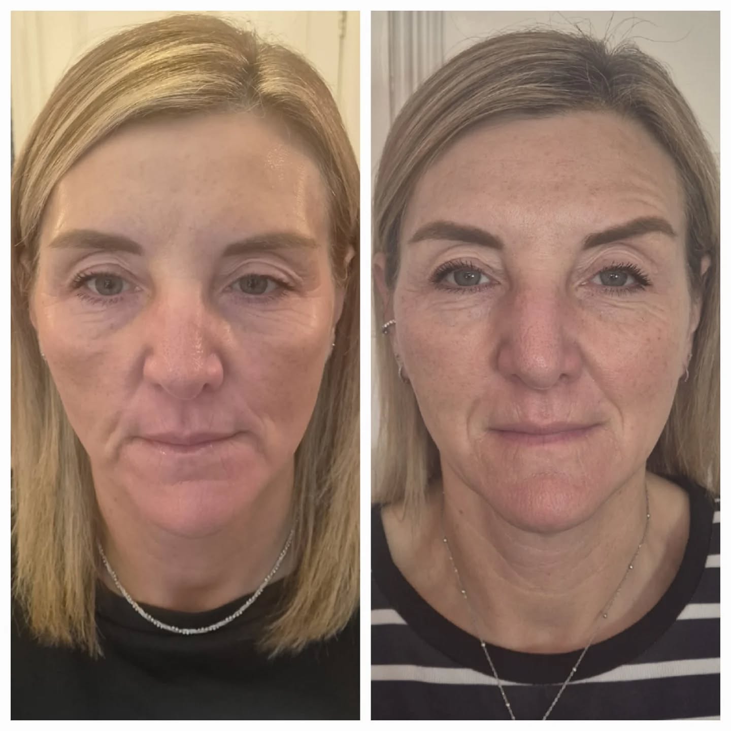 This is why I love Sculptra.
After significant weight loss, many people are left with loose skin, hollowing, loss of facial support, and a tired appearance. The challenge isn't always wrinkles. It's the loss of the underlying collagen and structure that once supported the face.
Unlike traditional fillers, Sculptra doesn't simply add volume. It works by stimulating your body's own collagen production, gradually rebuilding the skin's support network from within.
The result?
• Natural-looking volume restoration
• Improved skin quality and thickness
• Firmer, tighter skin
• A subtle lifting effect
• Improved facial contours
• Results that continue to improve over several months
• Long-lasting collagen stimulation
What I love most is that people rarely look like they've "had something done". They simply look fresher, healthier, less tired, and more like themselves.
In this before and after, you can see improved facial support, softening of hollow areas, better skin quality, and a more lifted appearance, all while maintaining a completely natural result.
If you've lost weight, are noticing facial volume loss, or feel your face looks less supported than it once did, Sculptra may be one of the most effective treatments available.
Because the goal isn't to change your face.
It's to restore what time, ageing, and weight loss have taken away.
Book a consultation to find out if Sculptra is right for you.
#Sculptra #CollagenStimulator #WeightLossJourney #FacialRejuvenation #NaturalResults AestheticMedicine MedicalAesthetics SkinTightening CollagenBoosting HealthyAgeing ReemMedicalAesthetics