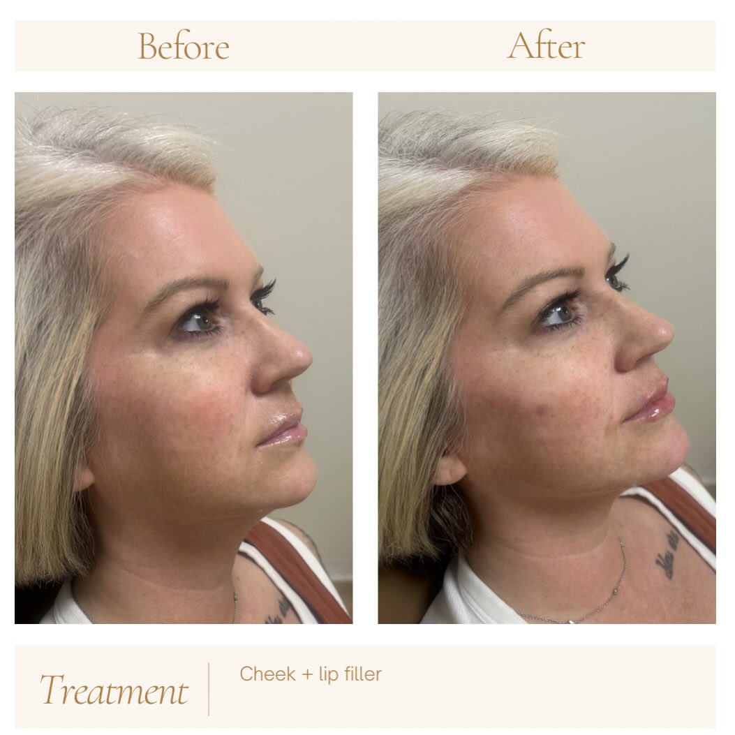 Cheek filler is one of the most misunderstood treatments in aesthetics.
A lot of people hear “cheek filler” and immediately think of overfilled, puffy, or unnatural results… but when done appropriately, subtle cheek support can completely rebalance the face in the most beautiful way.
As we age, the midface naturally loses volume and support. The cheeks begin to flatten and descend, which can contribute to:
– heaviness around the lower face
– deeper smile lines
– early jowling
– under-eye hollowing
– a more tired appearance overall
Sometimes the issue isn’t the fold itself — it’s the lack of support above it.
By strategically restoring volume to the midface, we can create a softer, lifted, more refreshed appearance while still looking completely natural. Think structure, support, and balance… not “more filler.”
Notice how she still looks like herself — just more rested, lifted, and balanced 🤍
That subtle change is the gold standard to me.